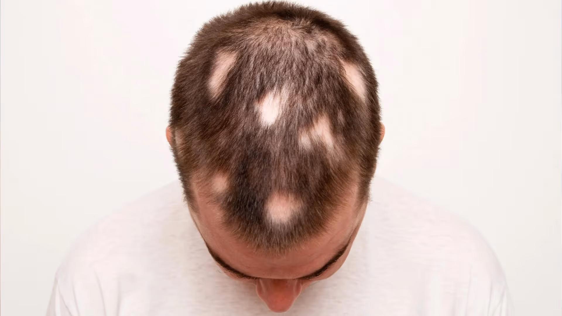 alopecia areata o caída de pelo por estrés