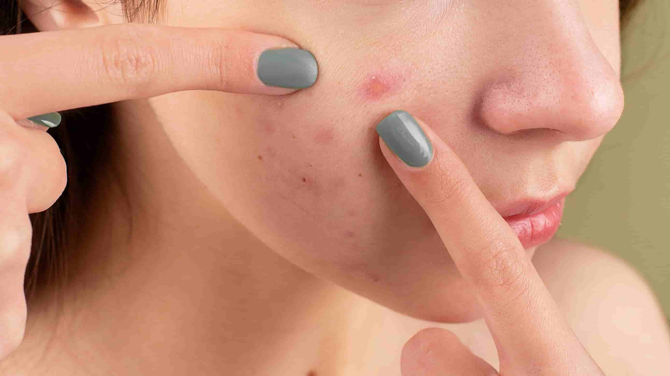conseguenze e rischi della dermatillomania