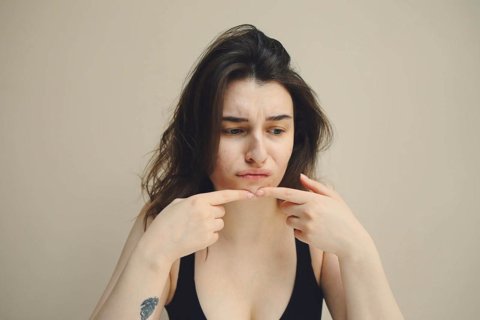 Acne da stress: quando la pelle ti parla