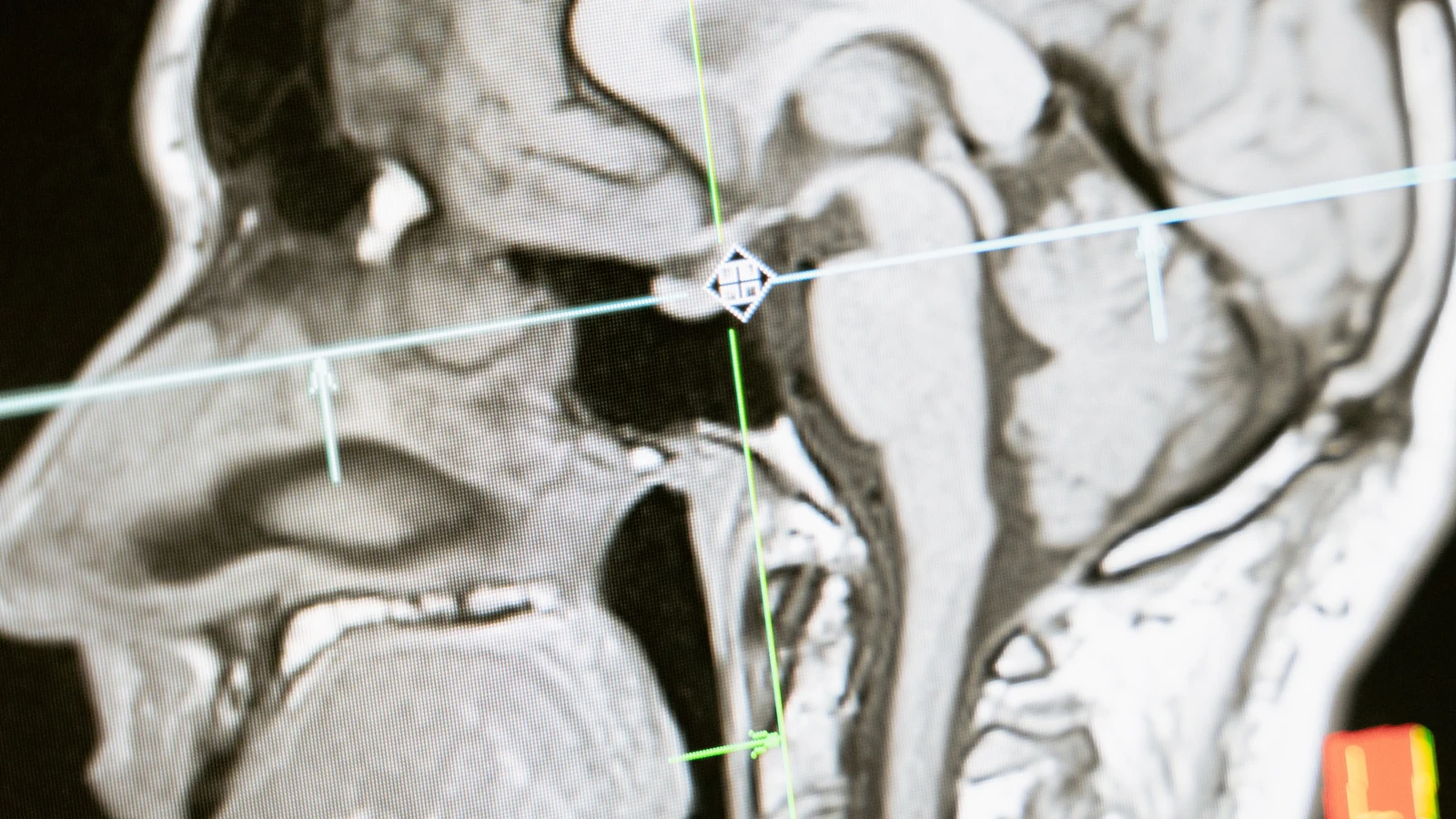 Primo piano di una scansione RM che mostra una vista sagittale del cervello umano per analisi.