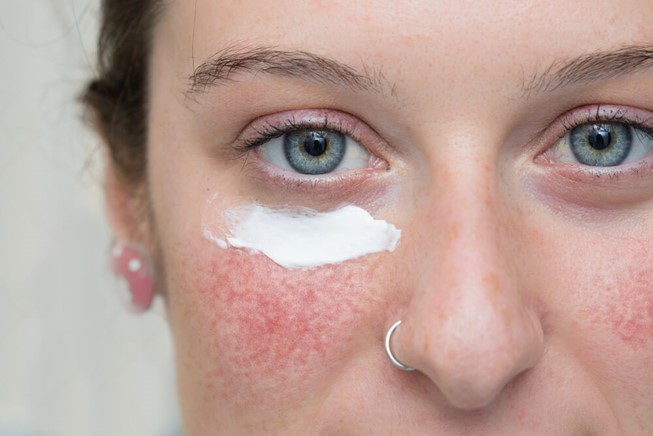 Custom prescription skincare for rosacea created through MiQuest’s AI skin analysis and dermatology