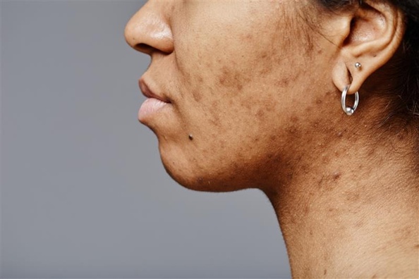 Clinically backed, AI-personalised skincare prescriptions by MiQuest