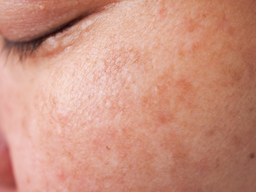 Why Supermarket Serums Aren’t Enough to Solve Pigmentation