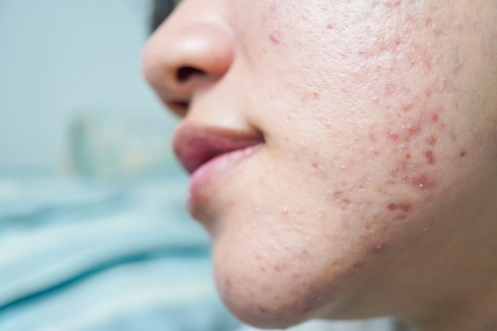 Acne face cream