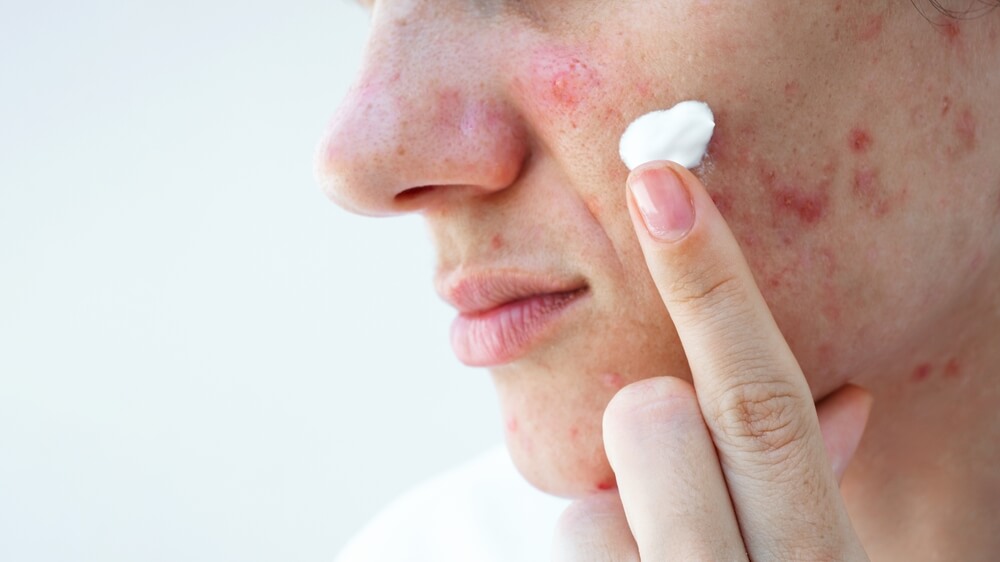 Prescription acne cream