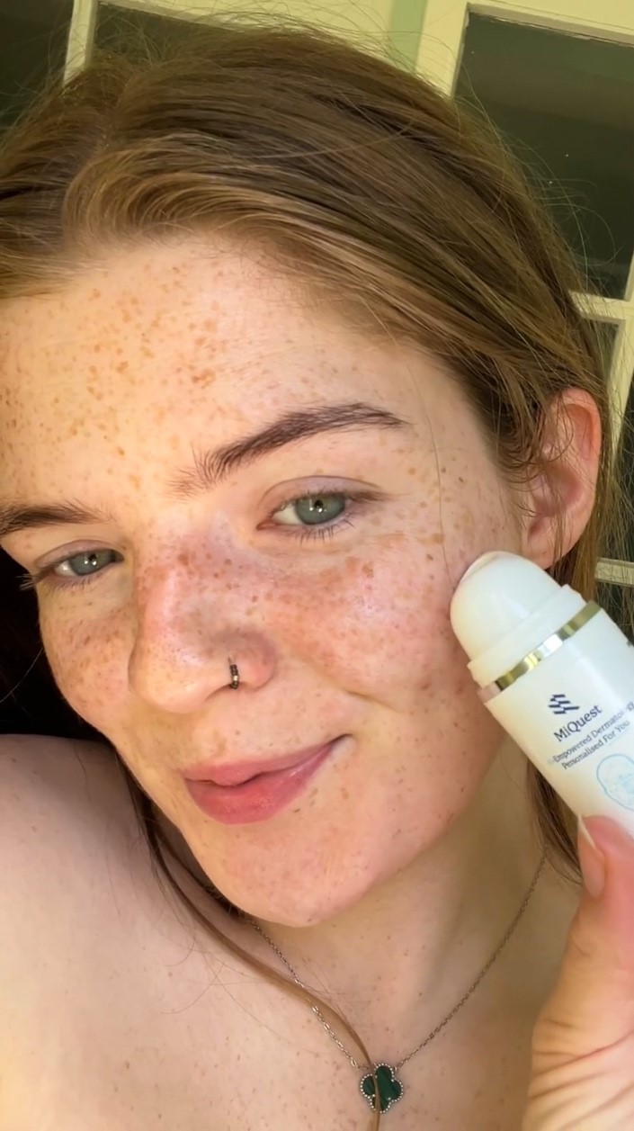 Before and after results of expert-led personalised skincare treatment for acne and pigmentation