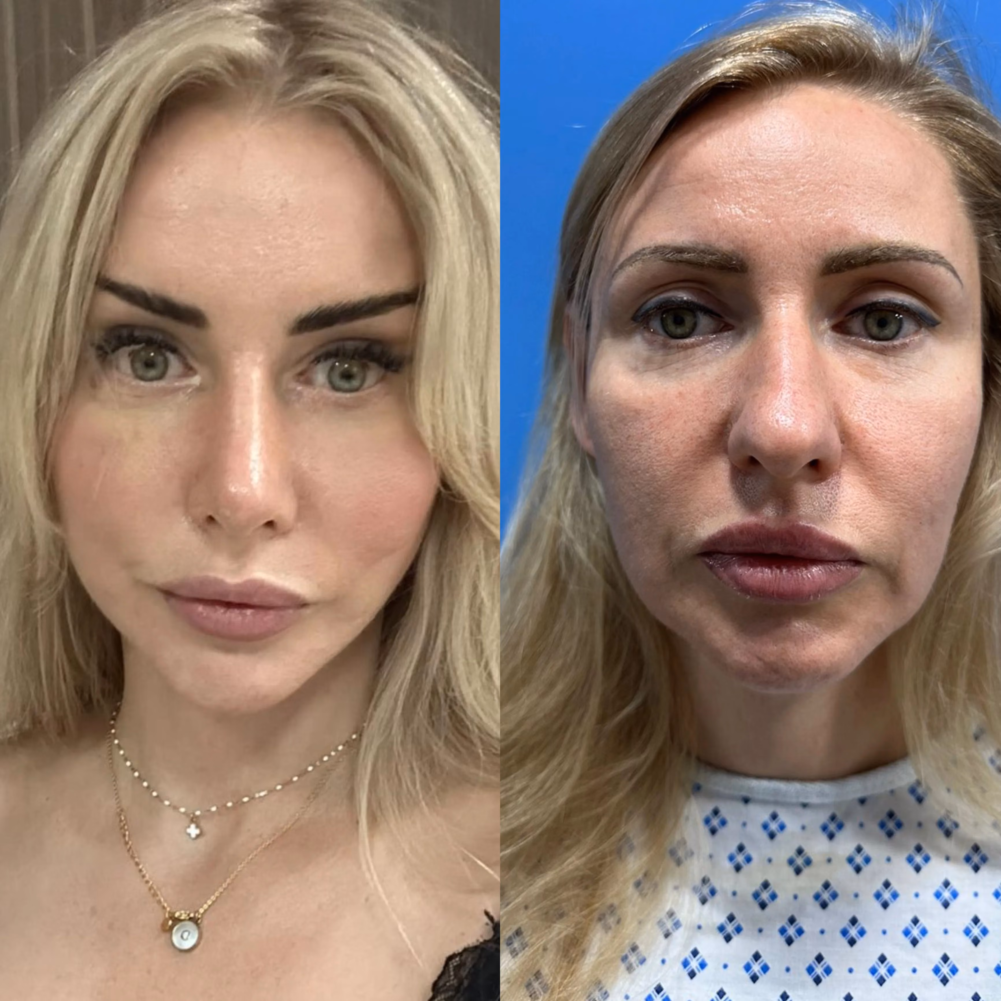 Facelift before-and-after, three-quarter view