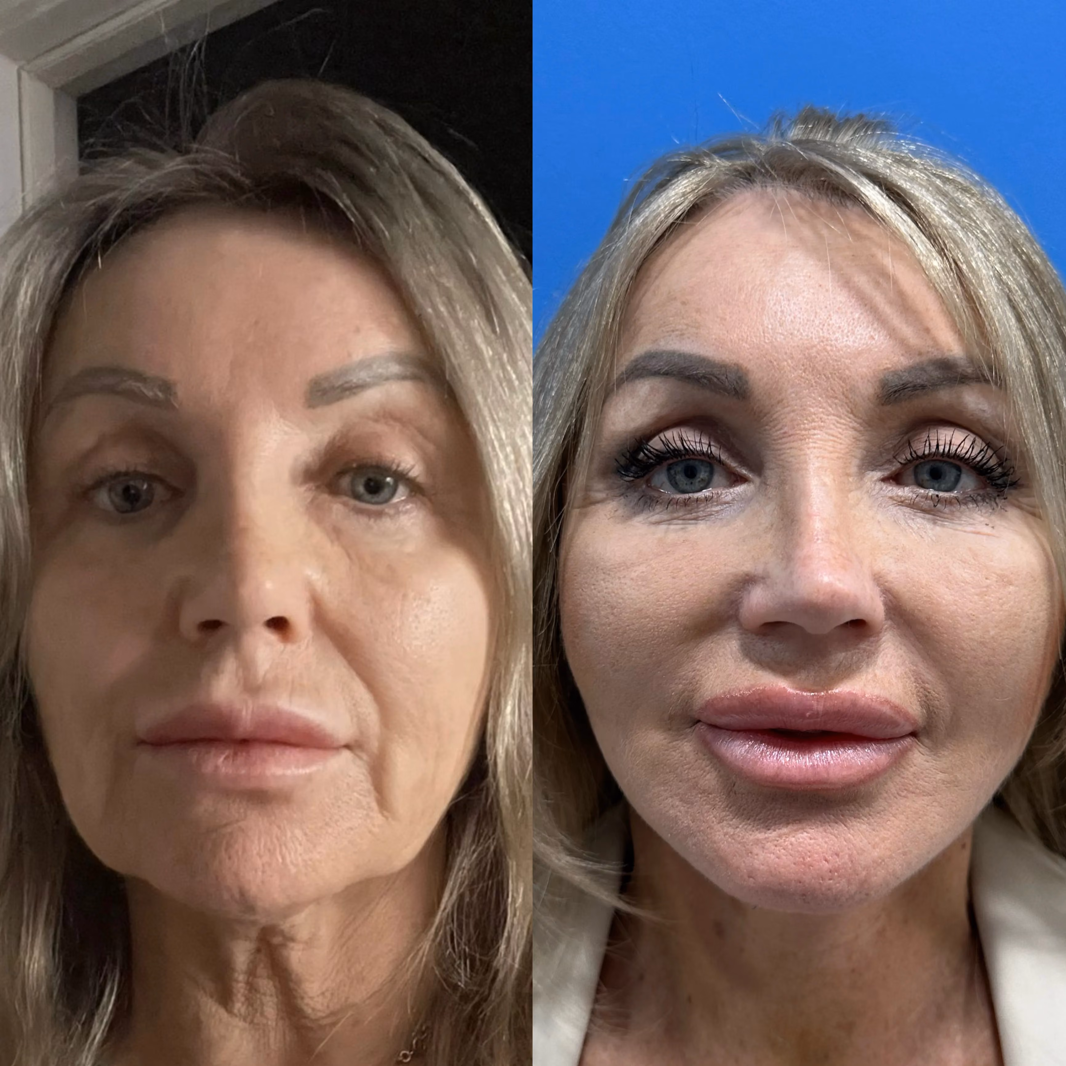 Facelift before-and-after, profile view