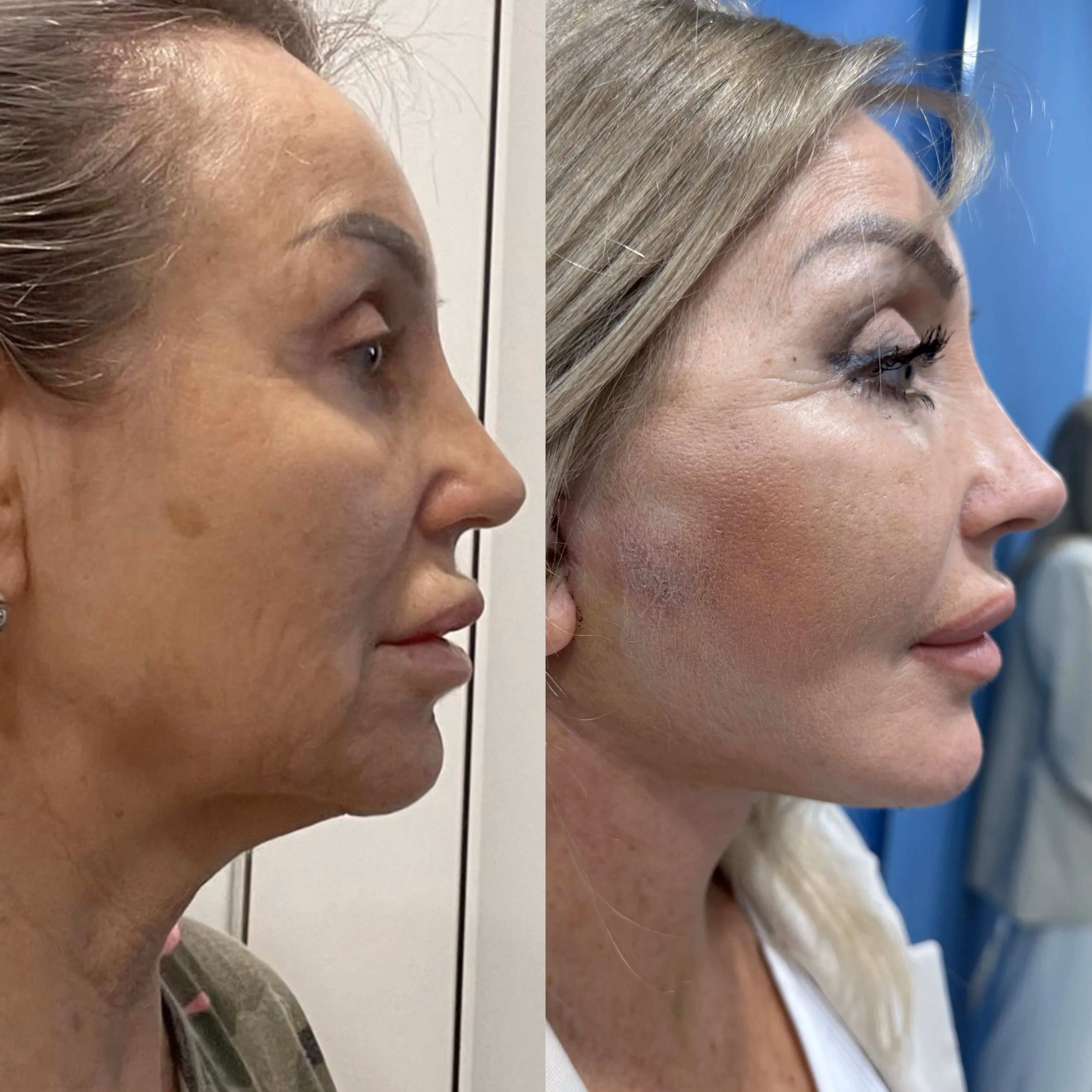 Facelift before-and-after, three-quarter view