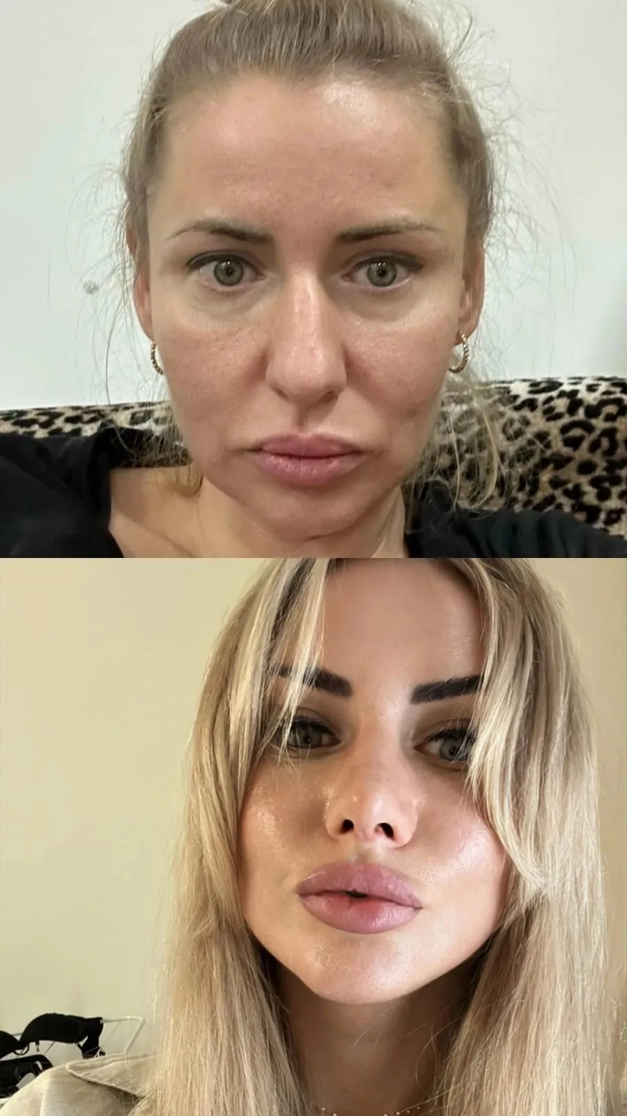 Facelift before-and-after, three-quarter view