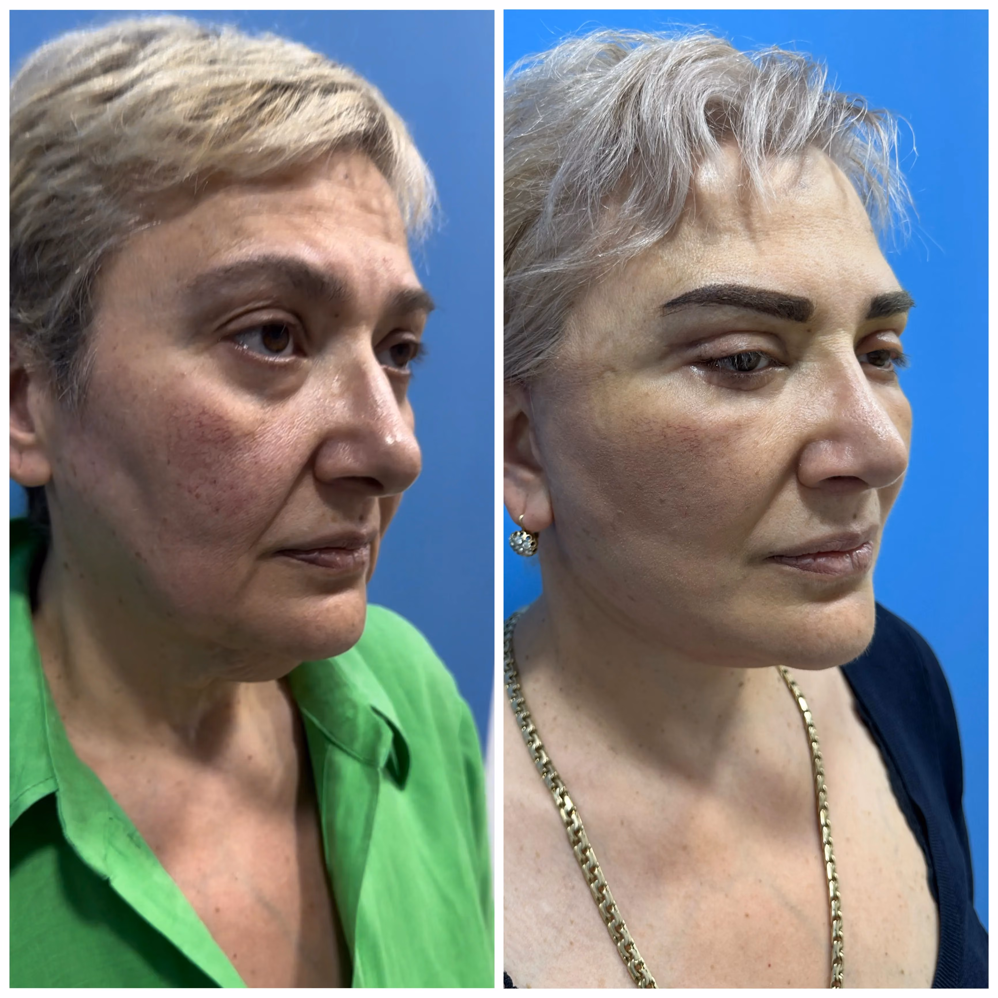 Facelift before-and-after, side view