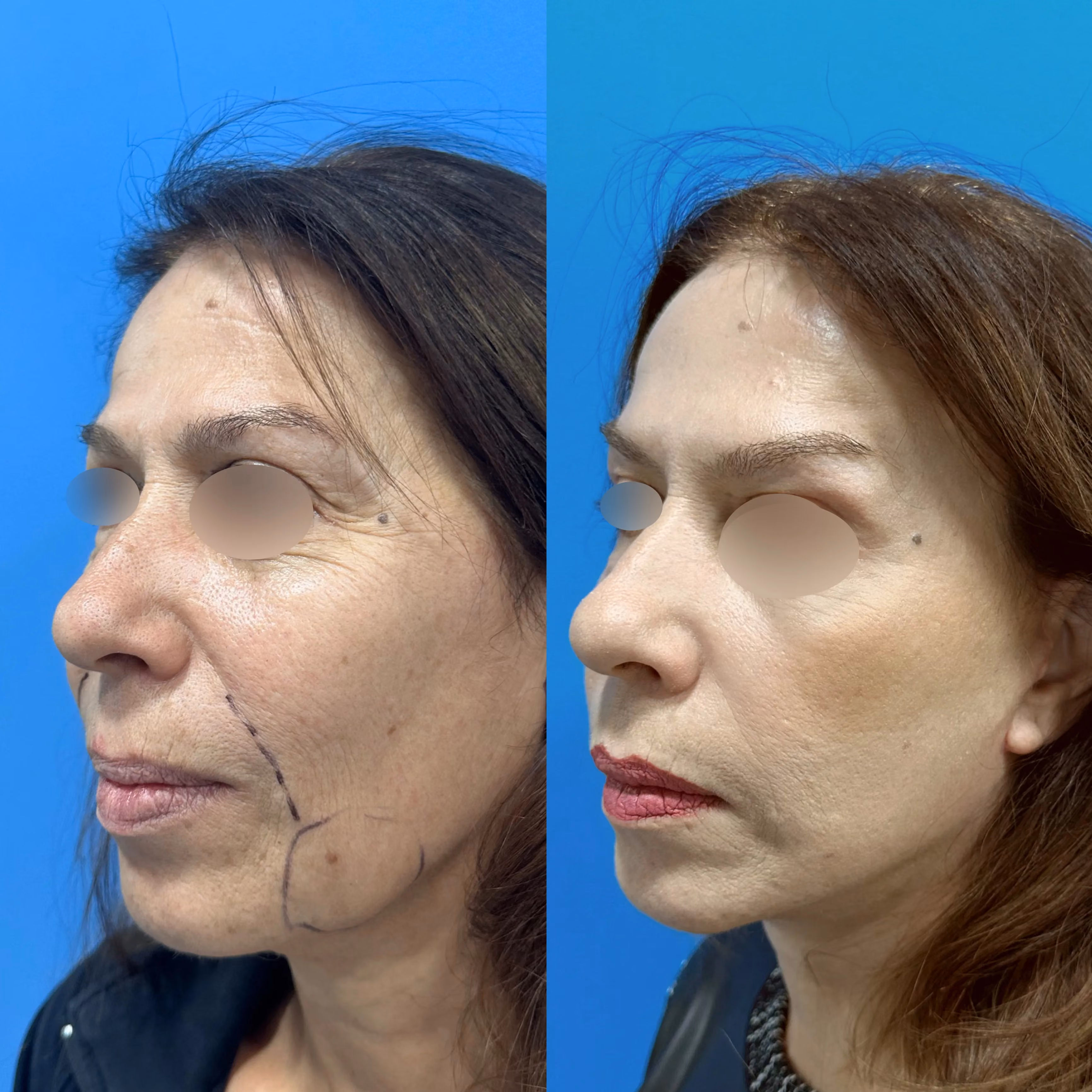 Facelift before-and-after, frontal view
