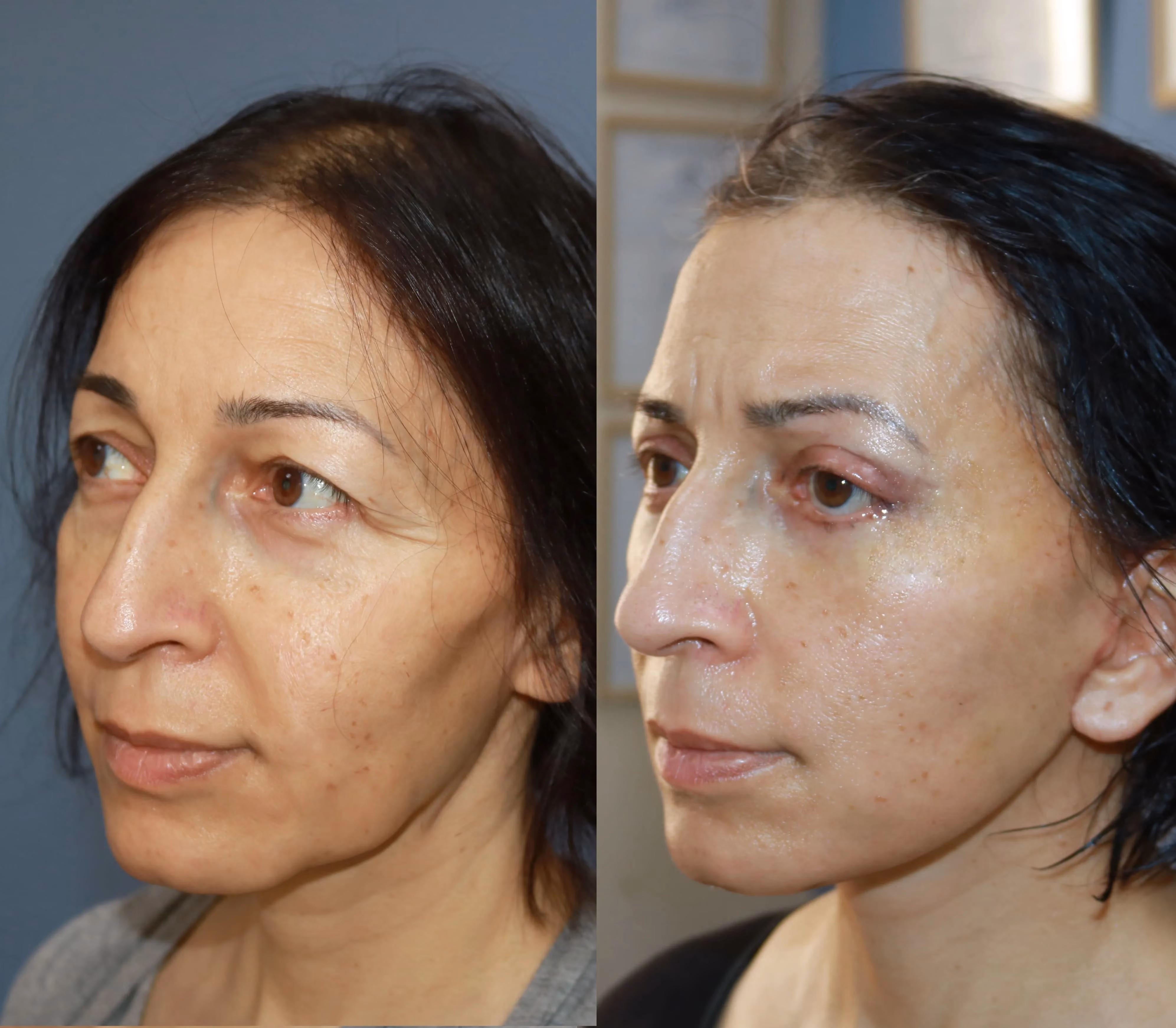 Facelift before-and-after, frontal view