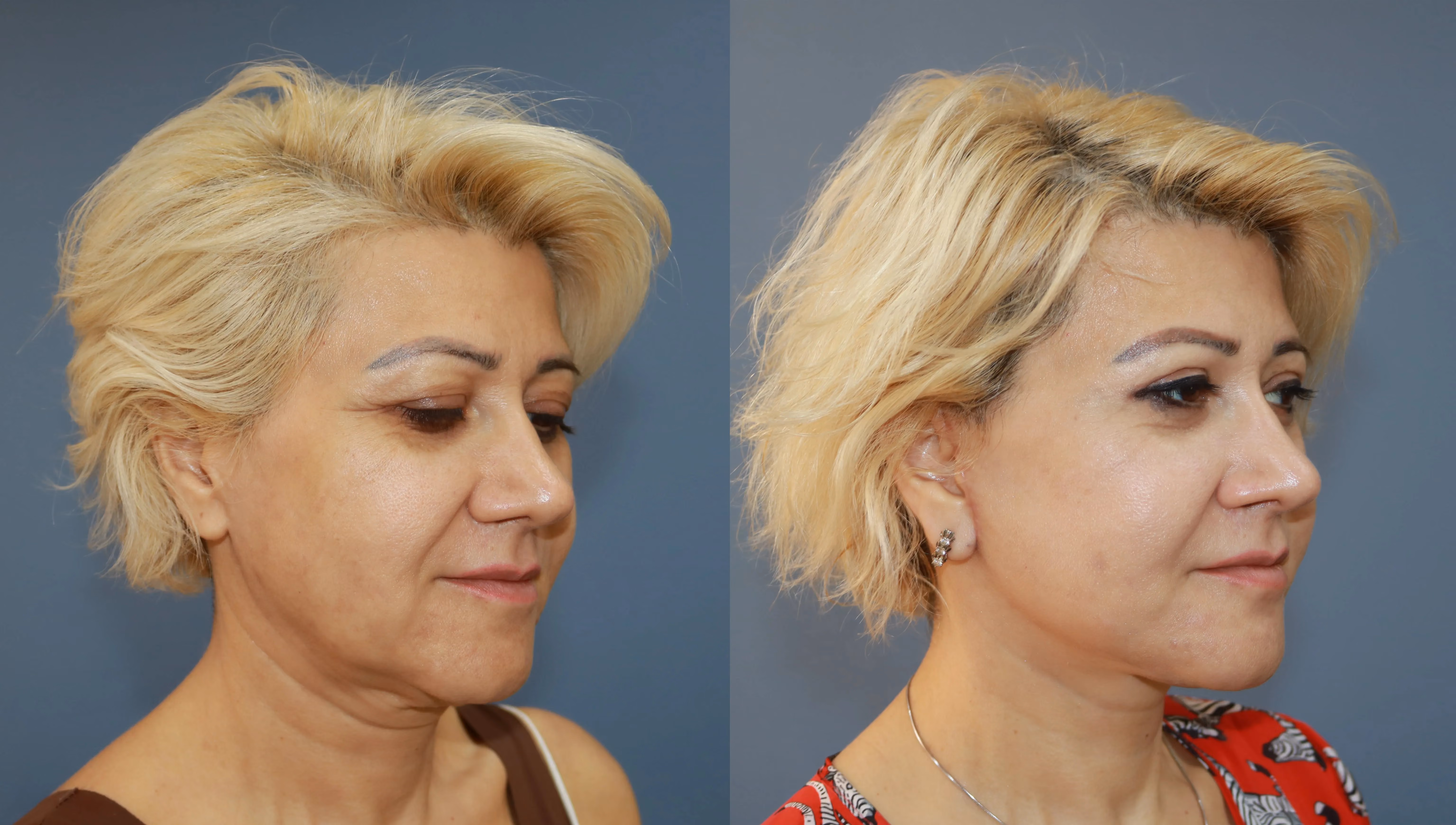 Facelift before-and-after, profile view