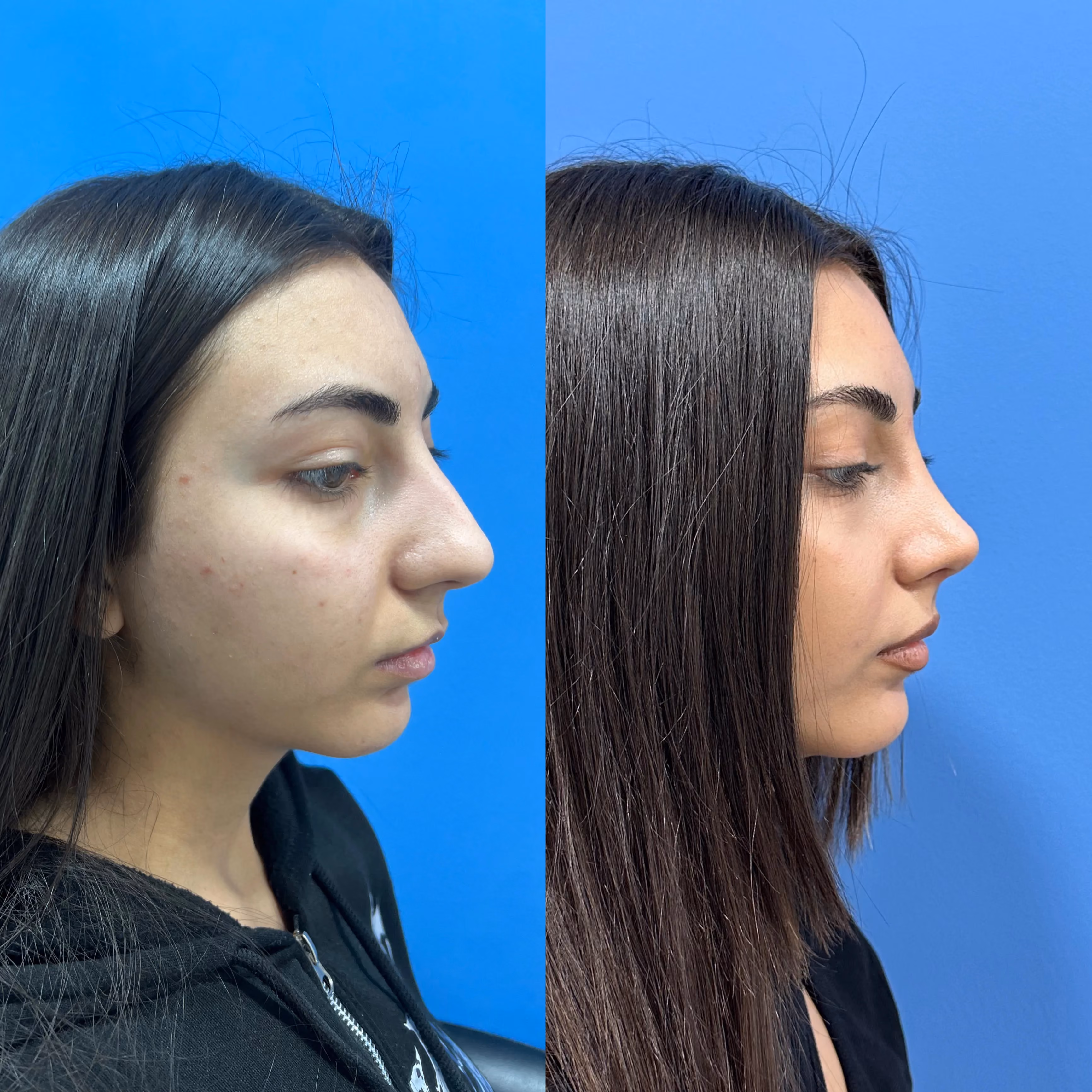 Rhinoplasty before-and-after, frontal view