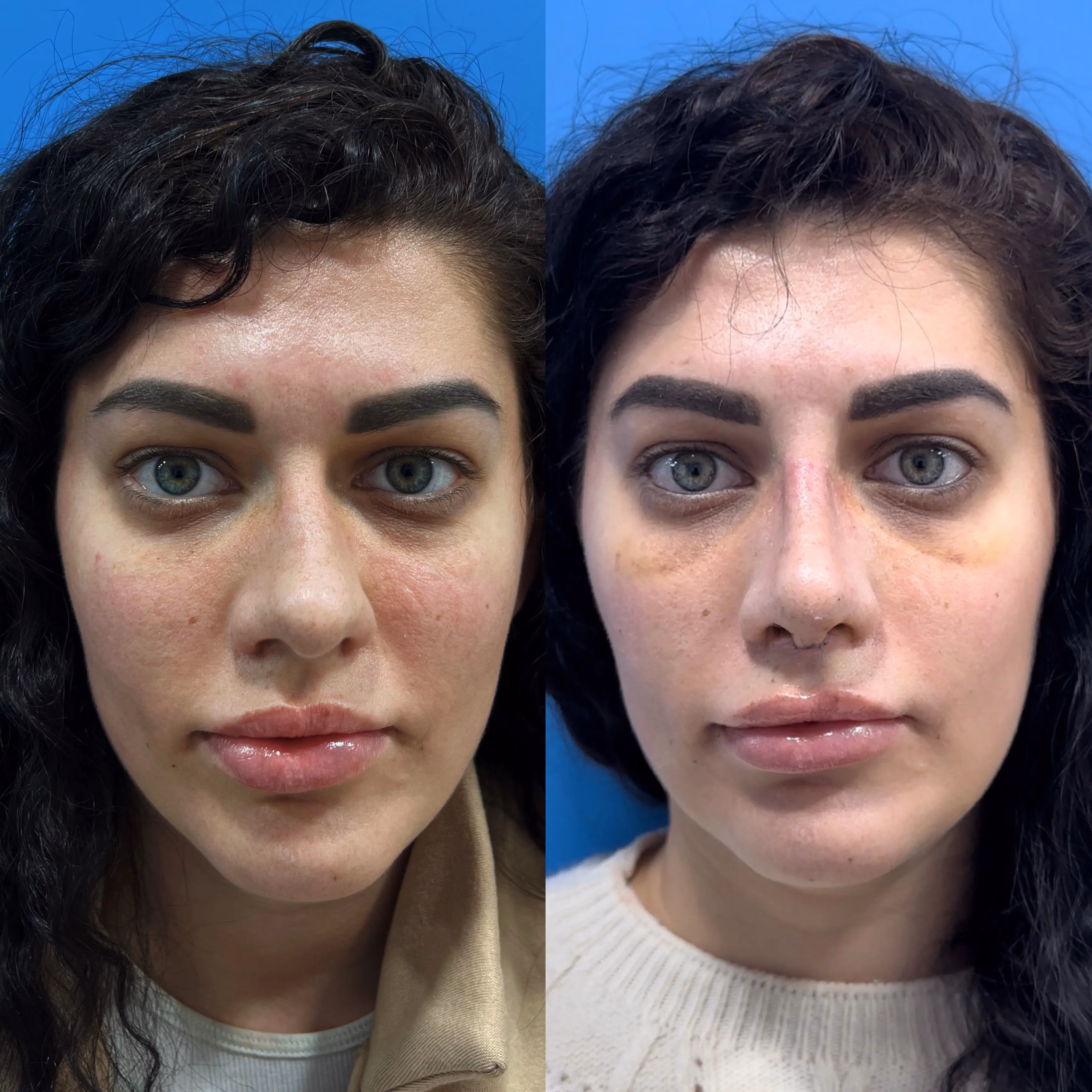 Rhinoplasty before-and-after, three-quarter view