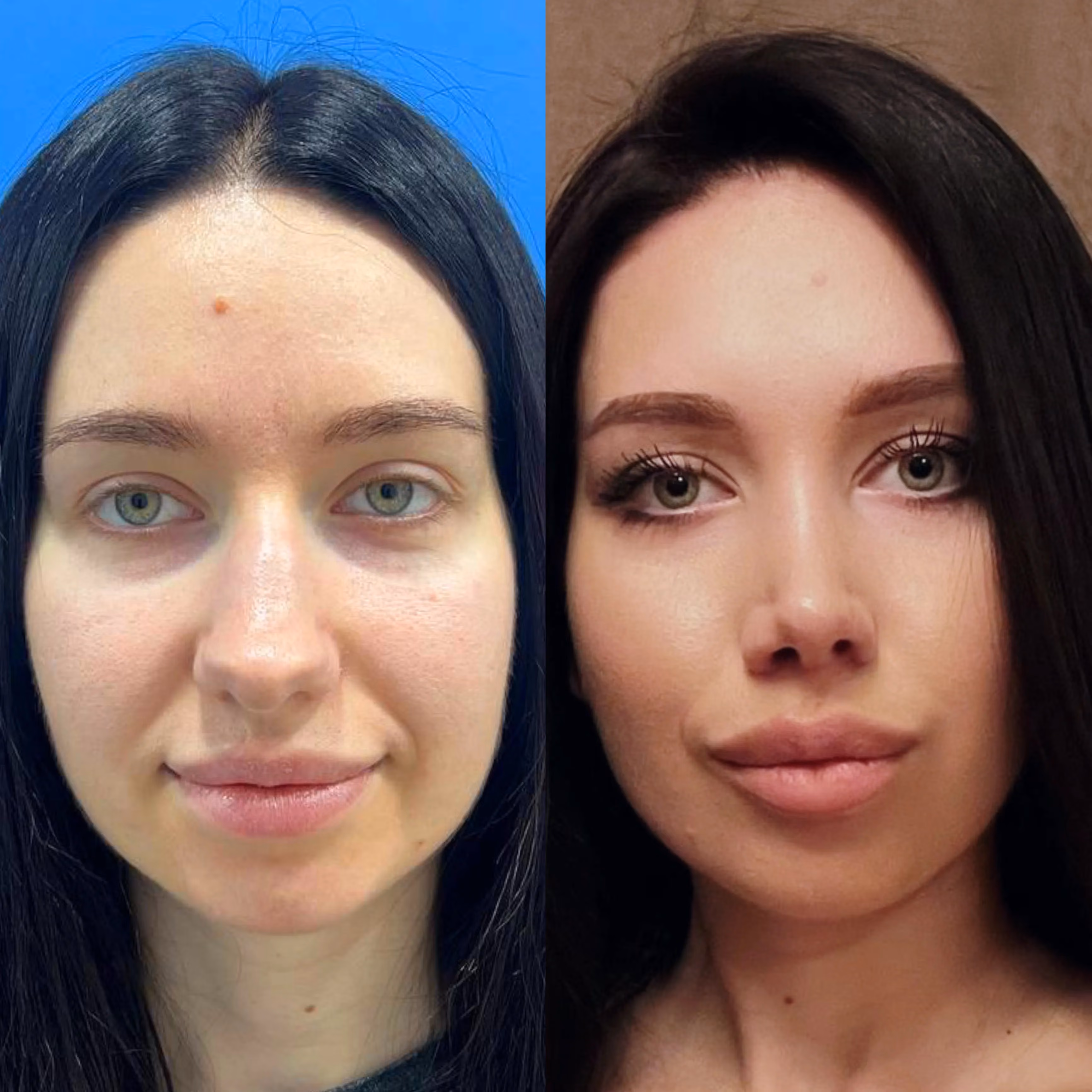 Rhinoplasty before-and-after, profile view