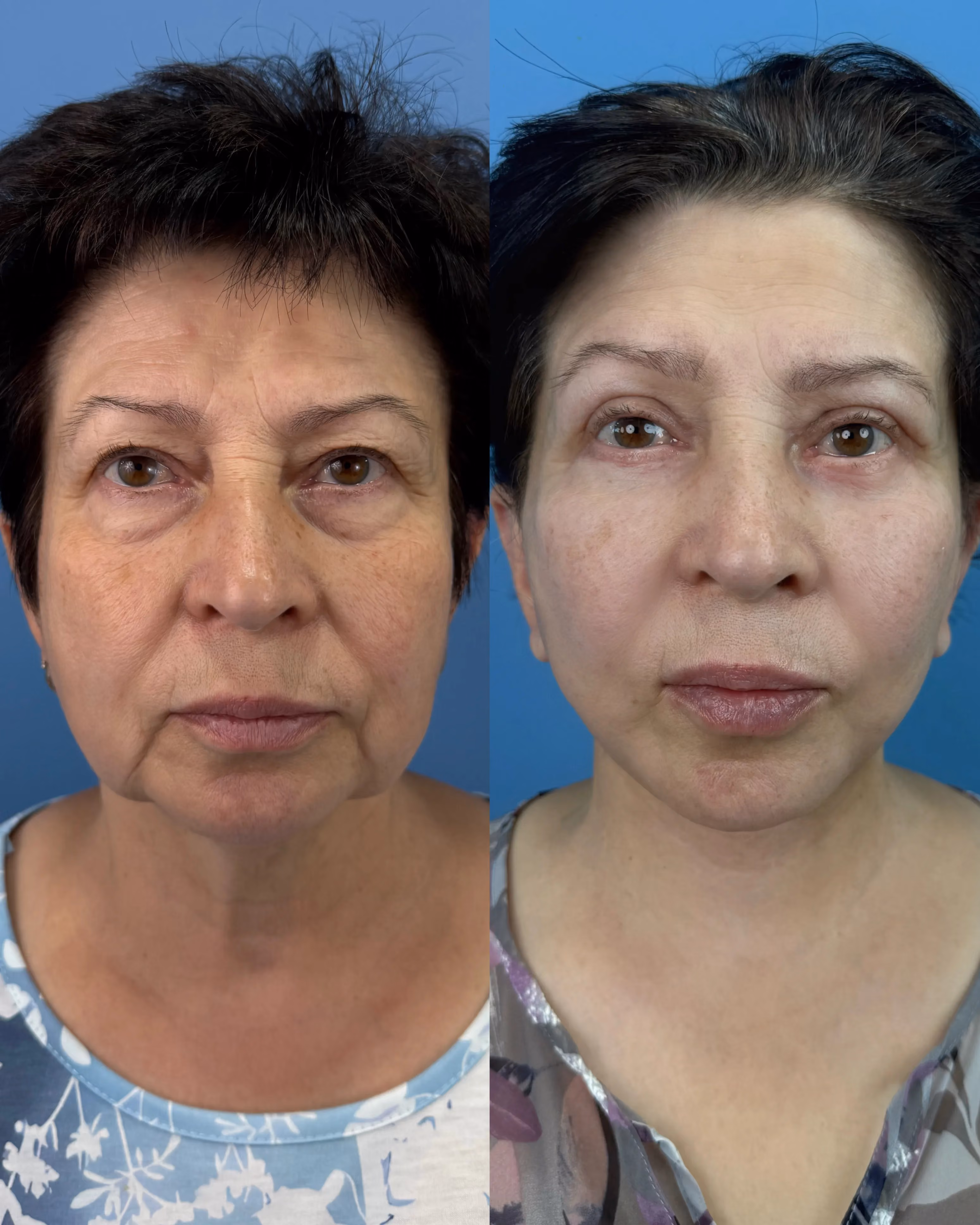 Deep-plane facelift before-and-after, frontal view