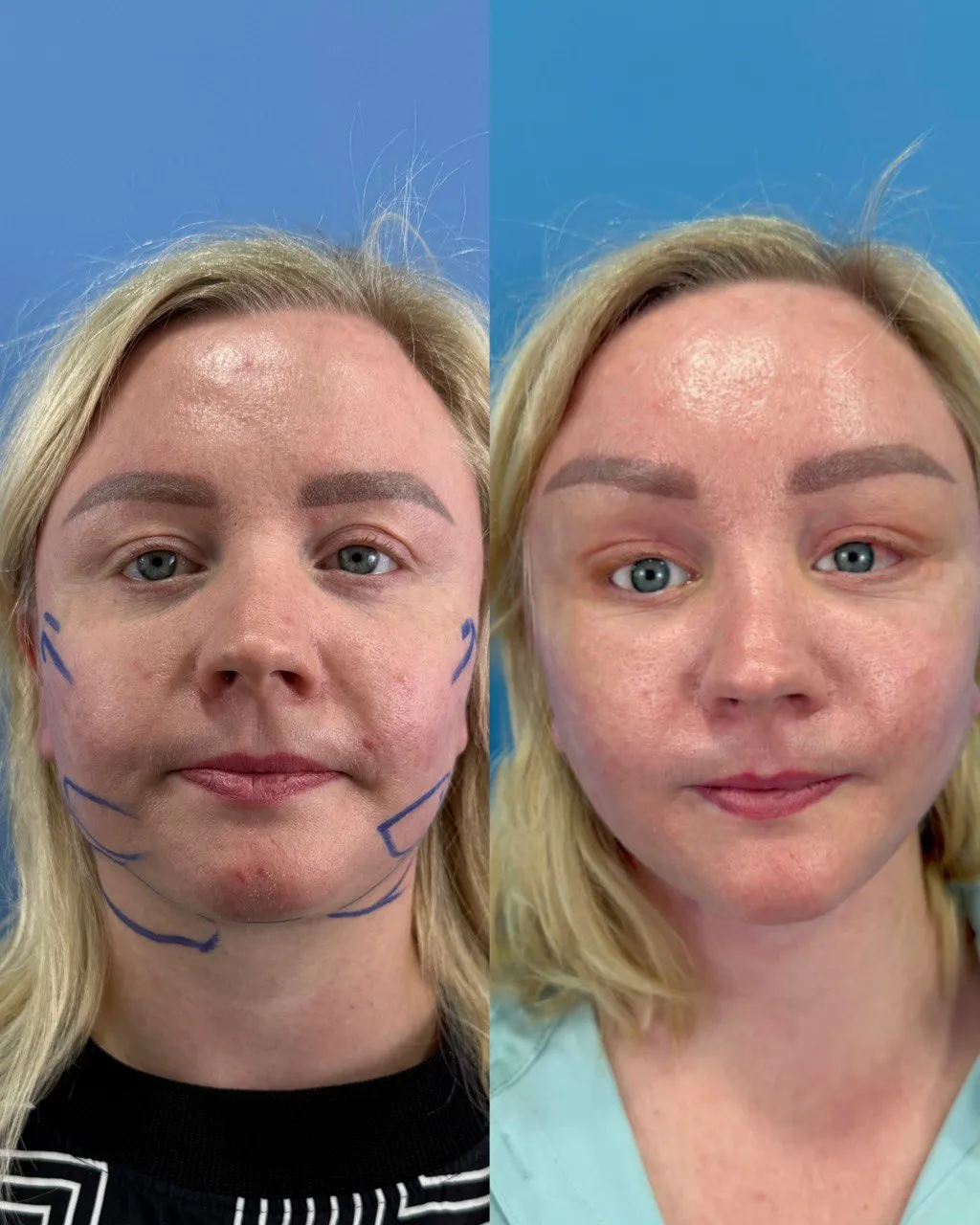 Deep-plane facelift postoperative result, side view