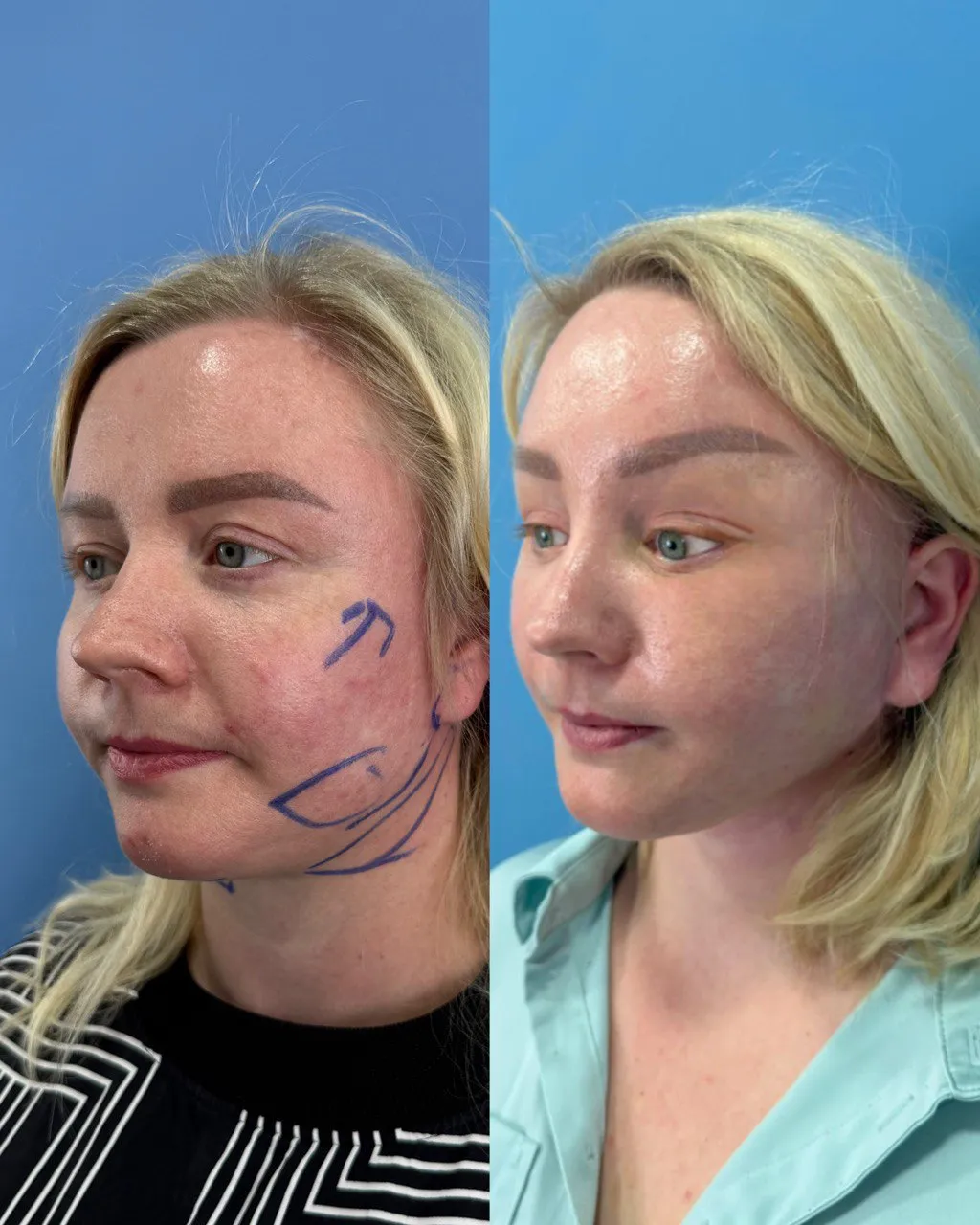 Deep-plane facelift postoperative result, frontal view