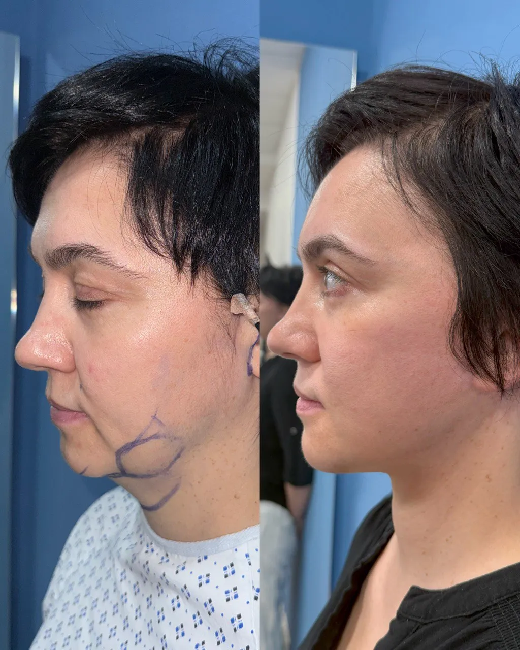 Deep-plane facelift postoperative result, three-quarter view