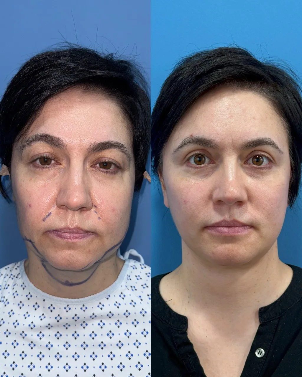 Deep-plane facelift postoperative result, profile view