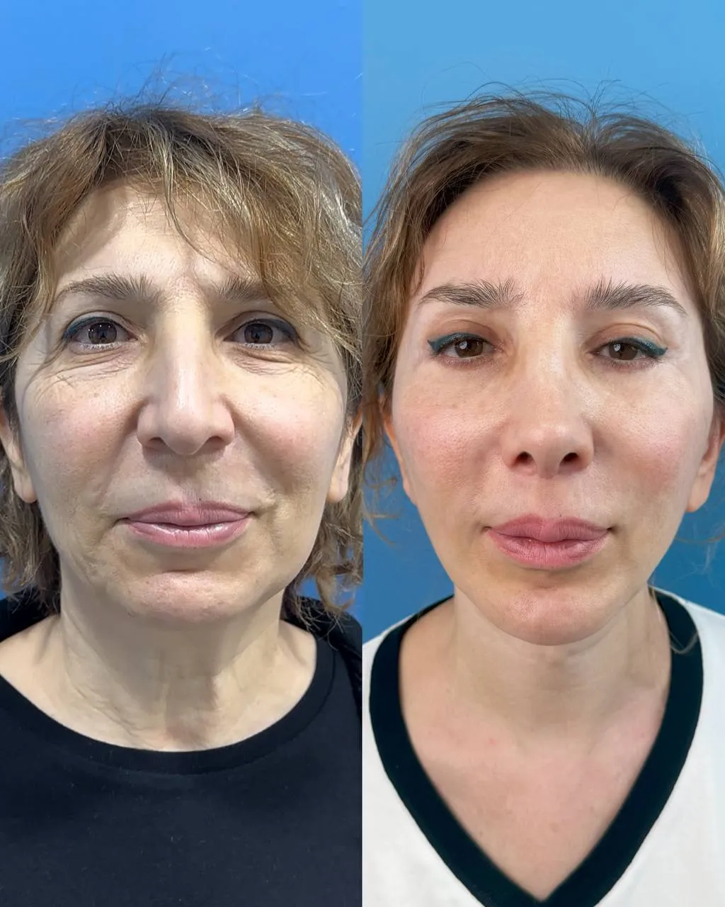 Deep-plane facelift before-and-after, frontal view