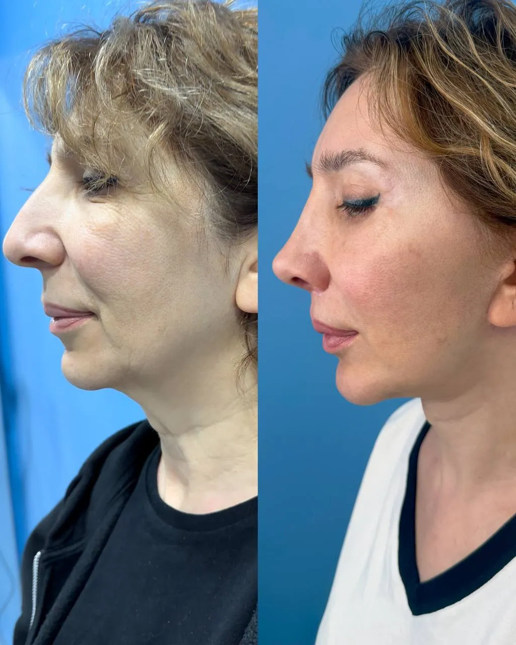 Deep-plane facelift before-and-after, side view