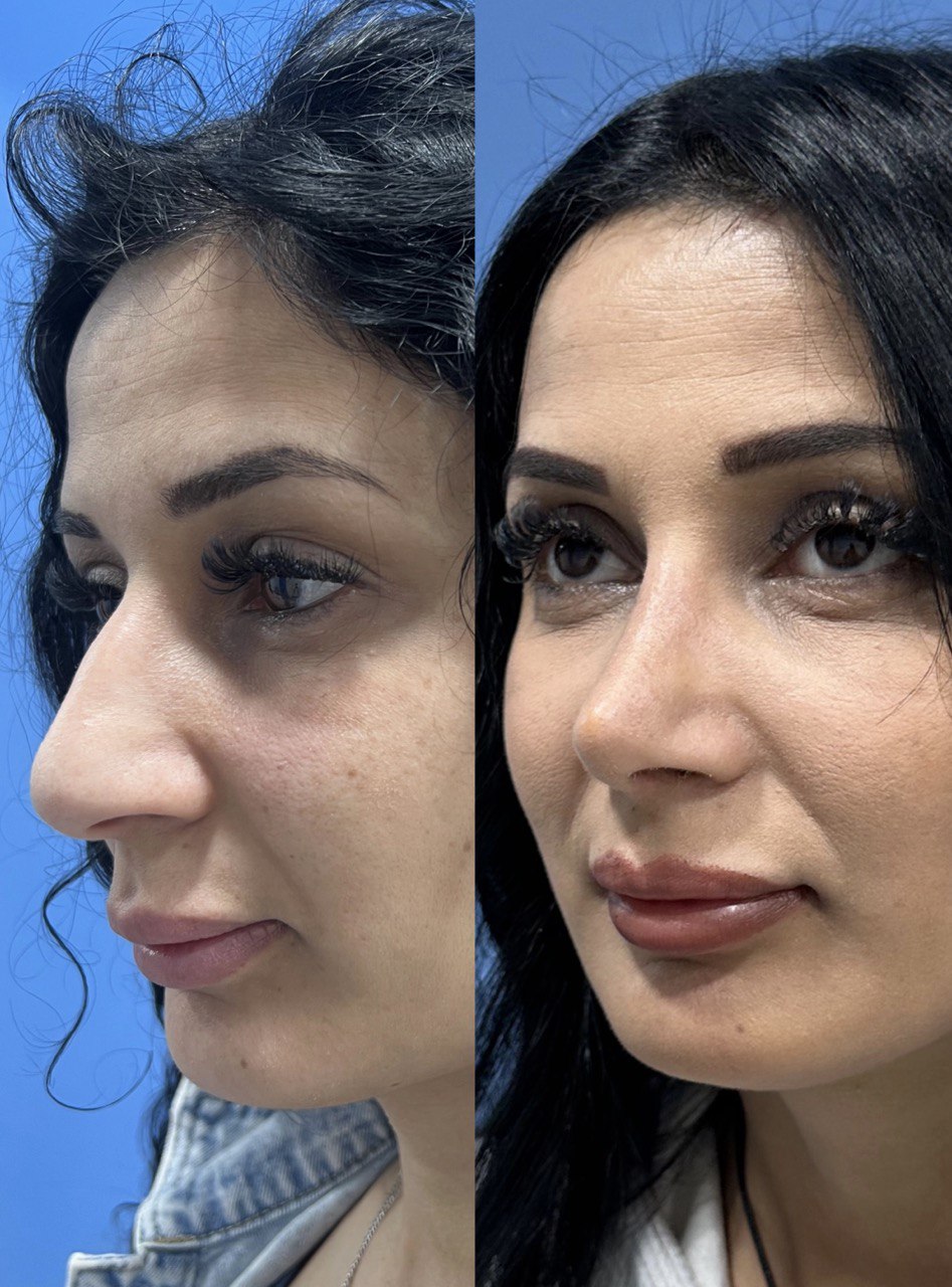 “This patient underwent rhinoplasty for profile refinement, achieving a smooth nasal dorsum and natural tip contour.”
