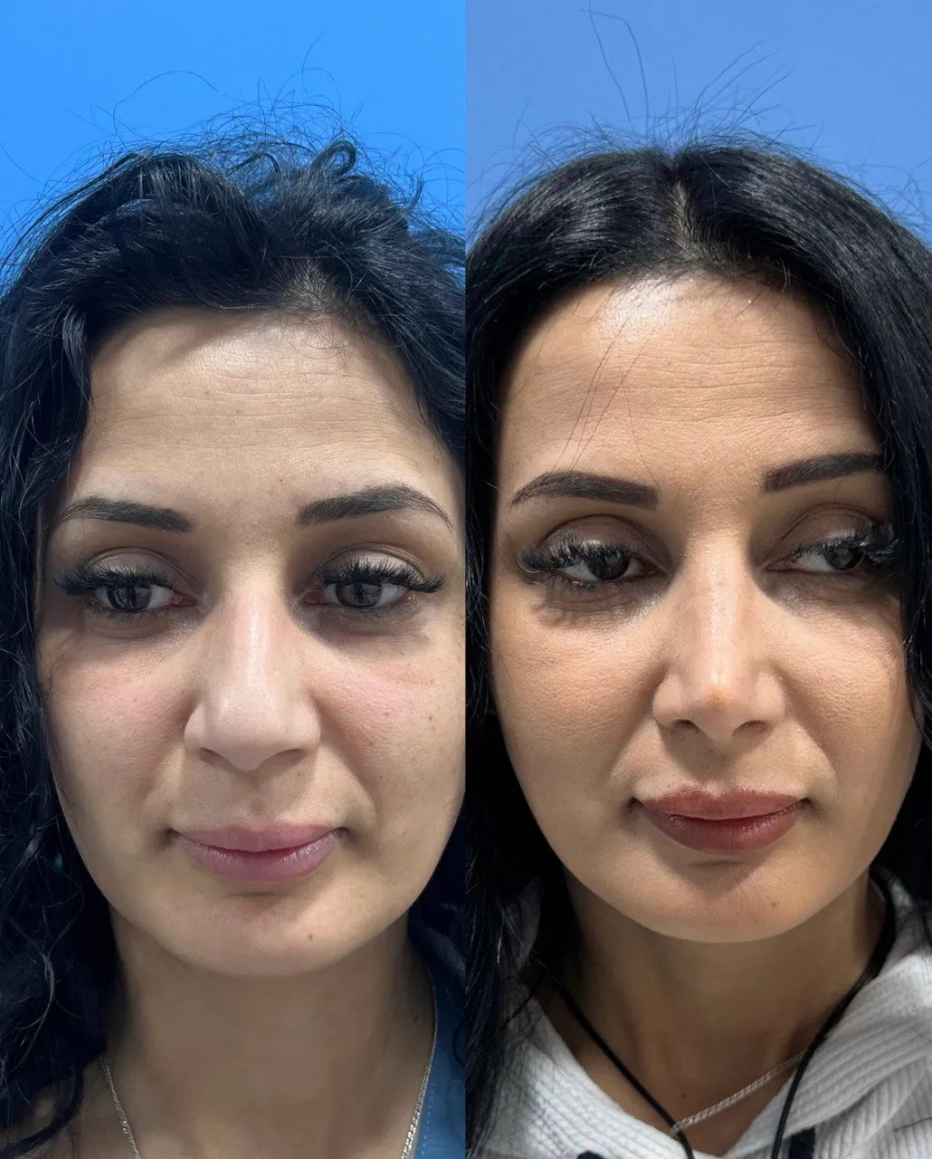 Rhinoplasty postoperative result, three-quarter view