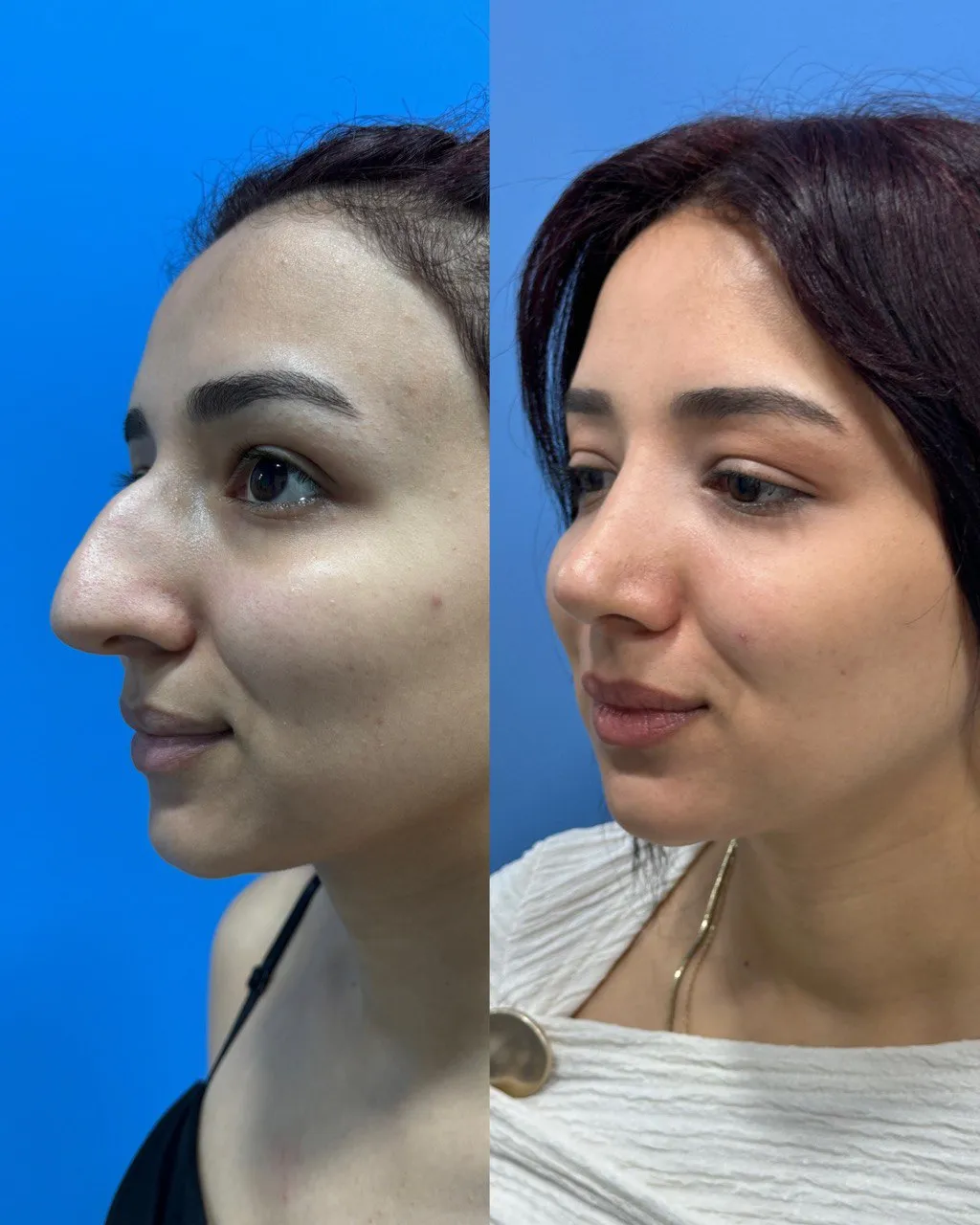 Rhinoplasty before-and-after, side view
