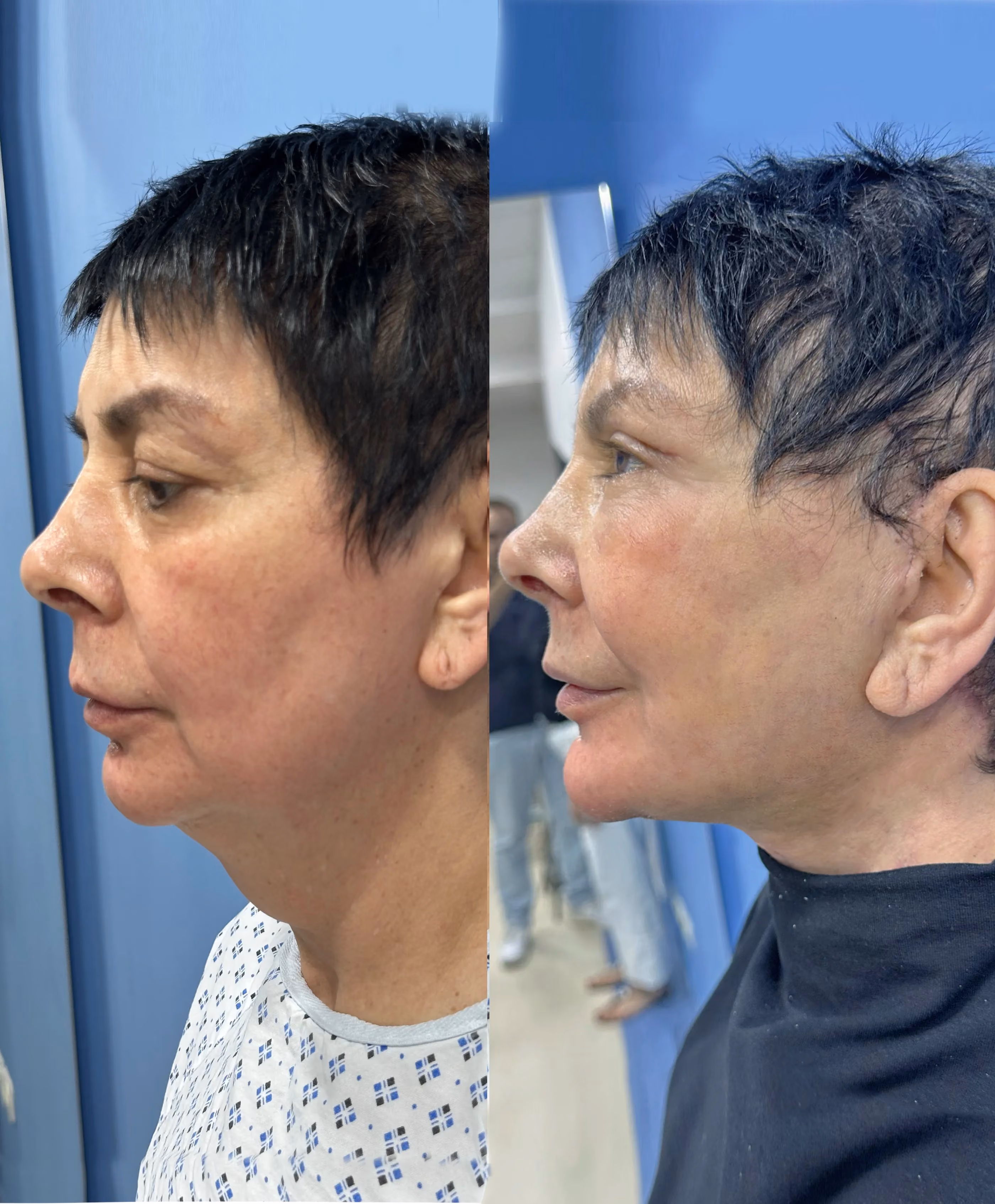Deep-plane facelift before-and-after, frontal view
