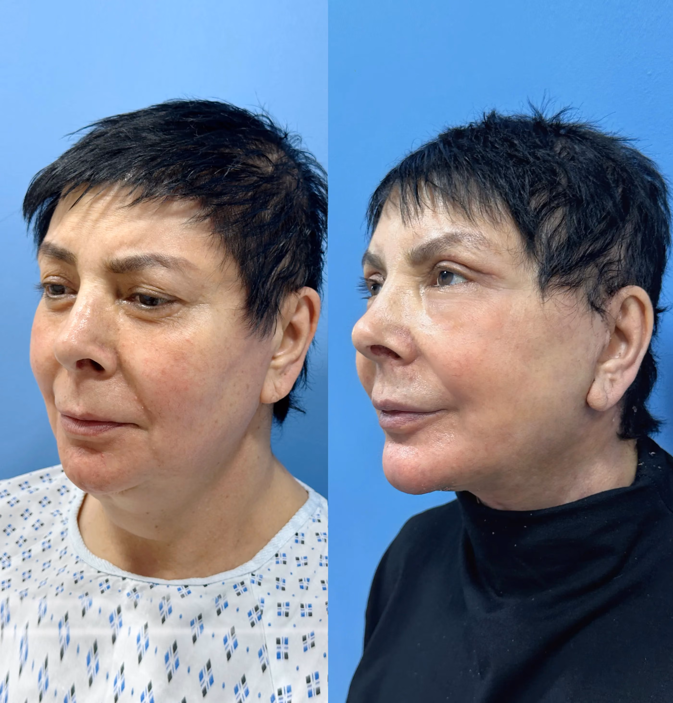 Deep-plane facelift before-and-after, paired views