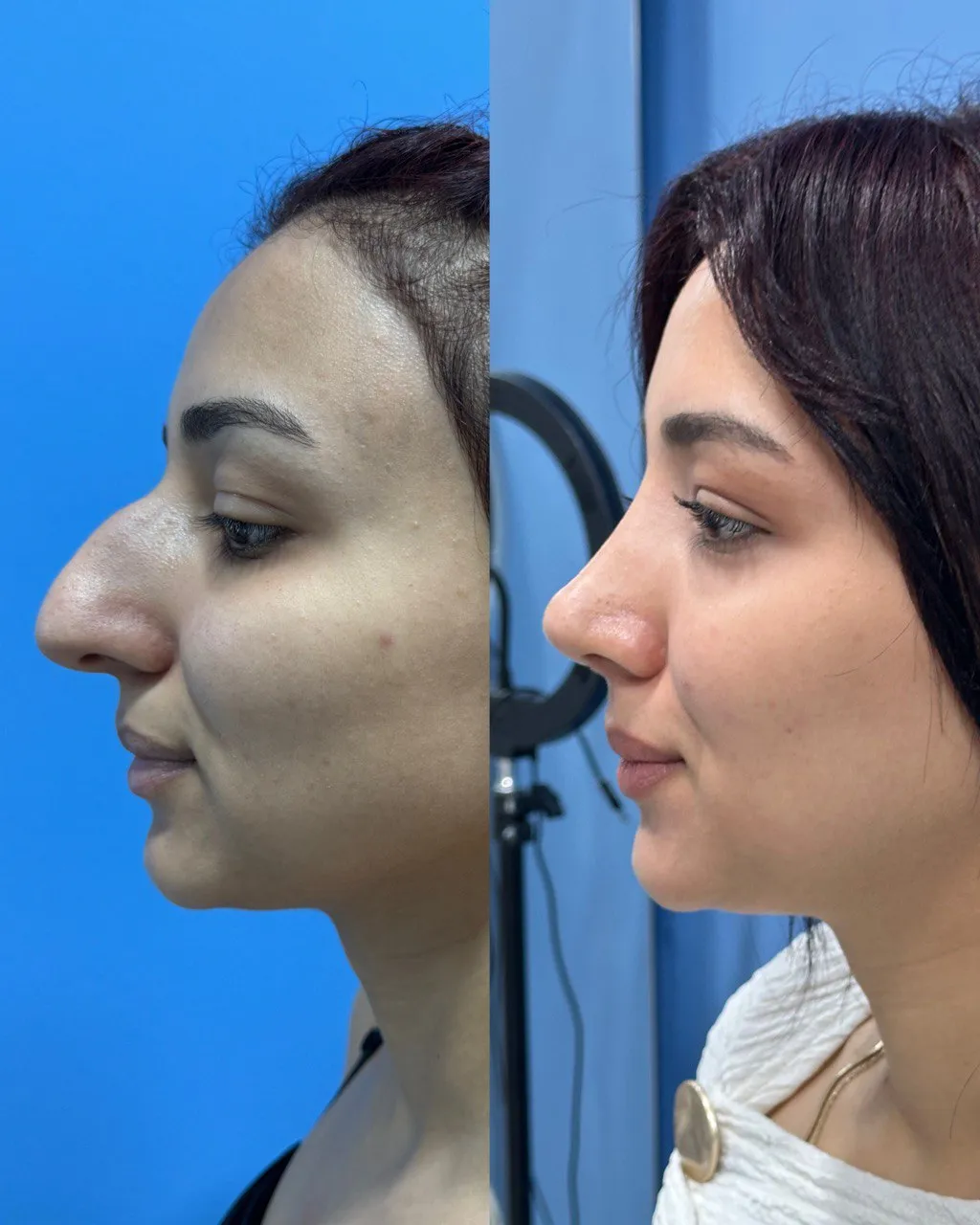 Rhinoplasty before-and-after, side view