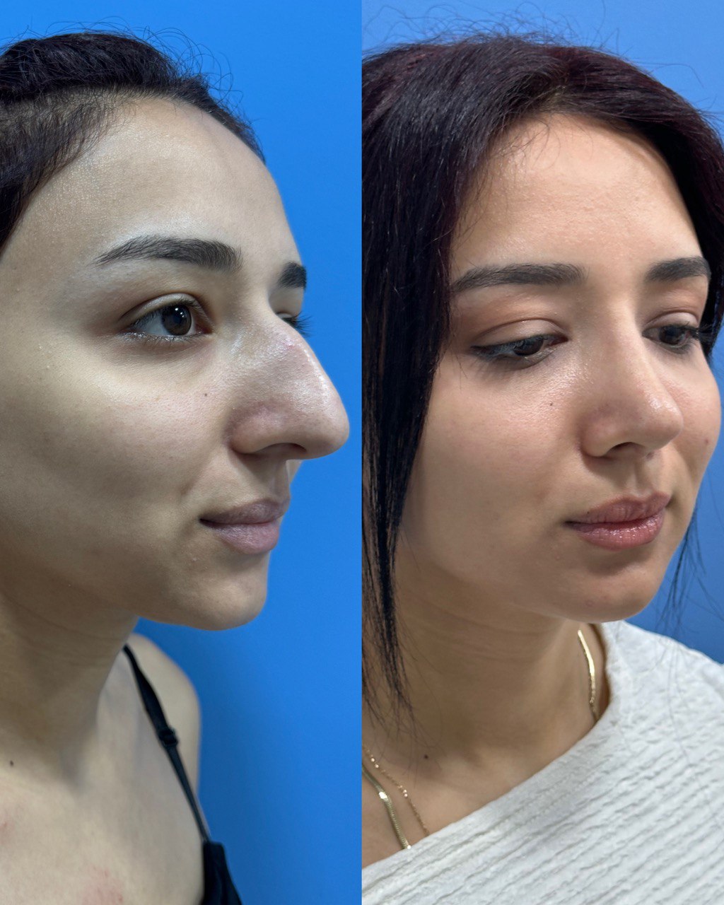 “Before and after rhinoplasty improving nasal bridge harmony and overall facial balance. Surgery by Dr. Telman Arakelyan in Yerevan.”

