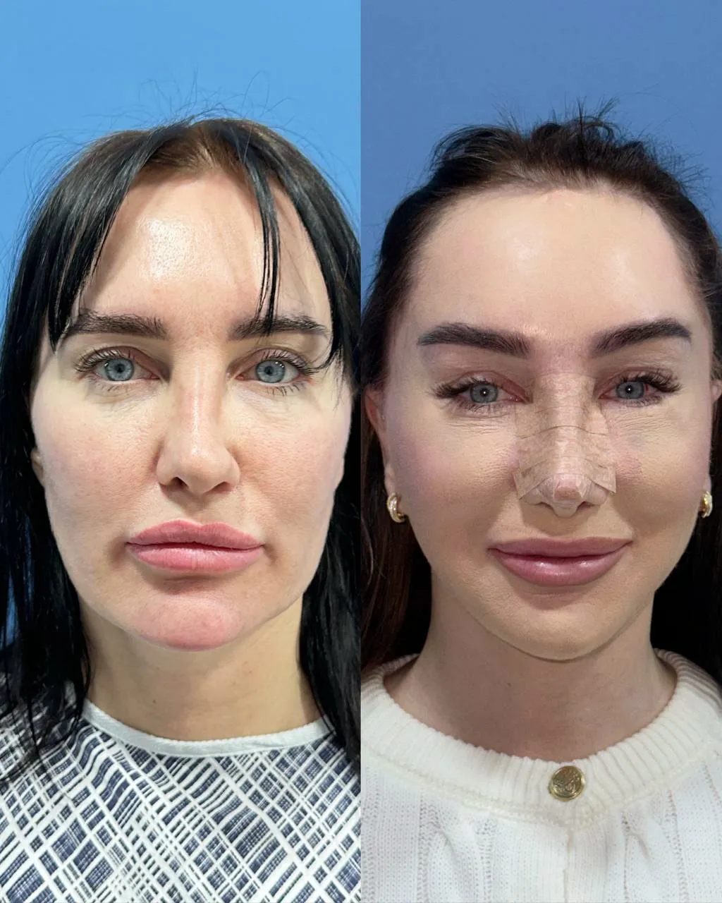 Revision deep-plane facelift and endoscopic brow lift before-and-after, frontal view
