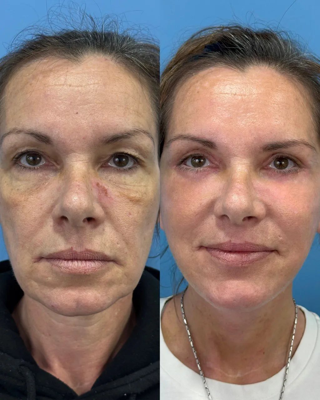 Deep-plane facelift before-and-after, frontal view