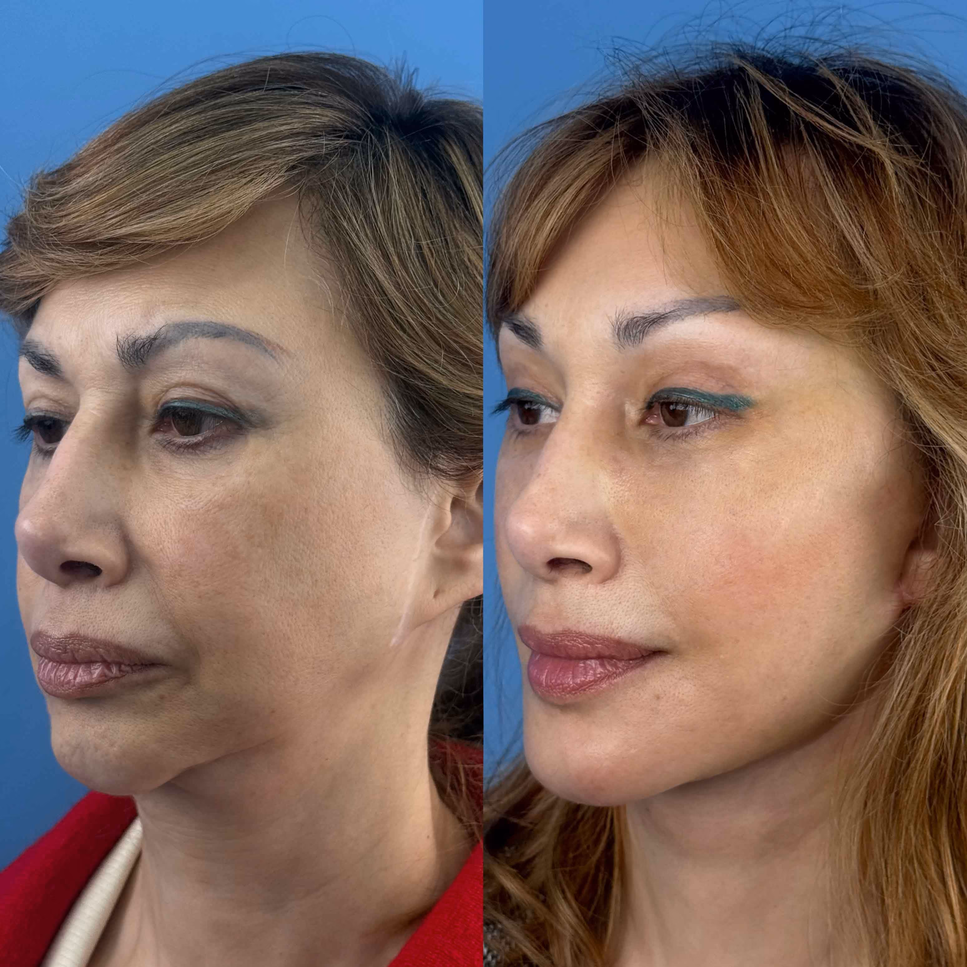 Deep-plane face and neck lift result, three-quarter view