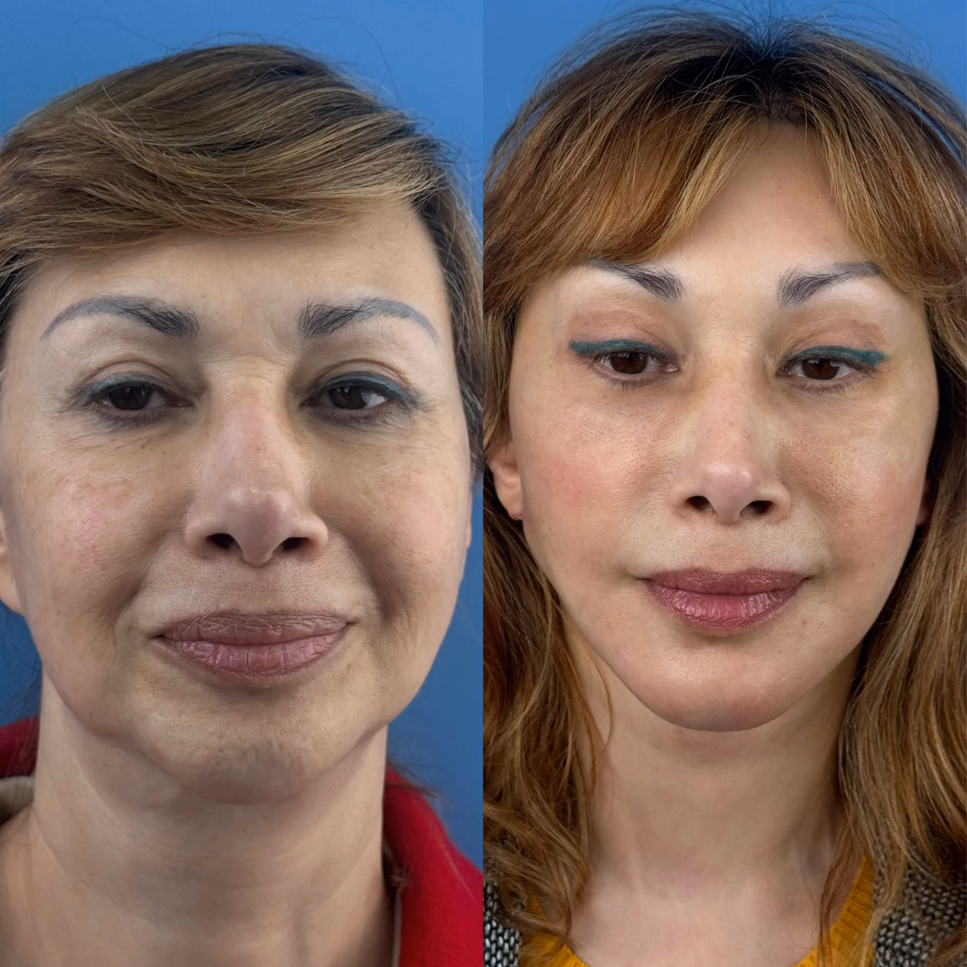 Deep-plane facelift postoperative result, frontal view