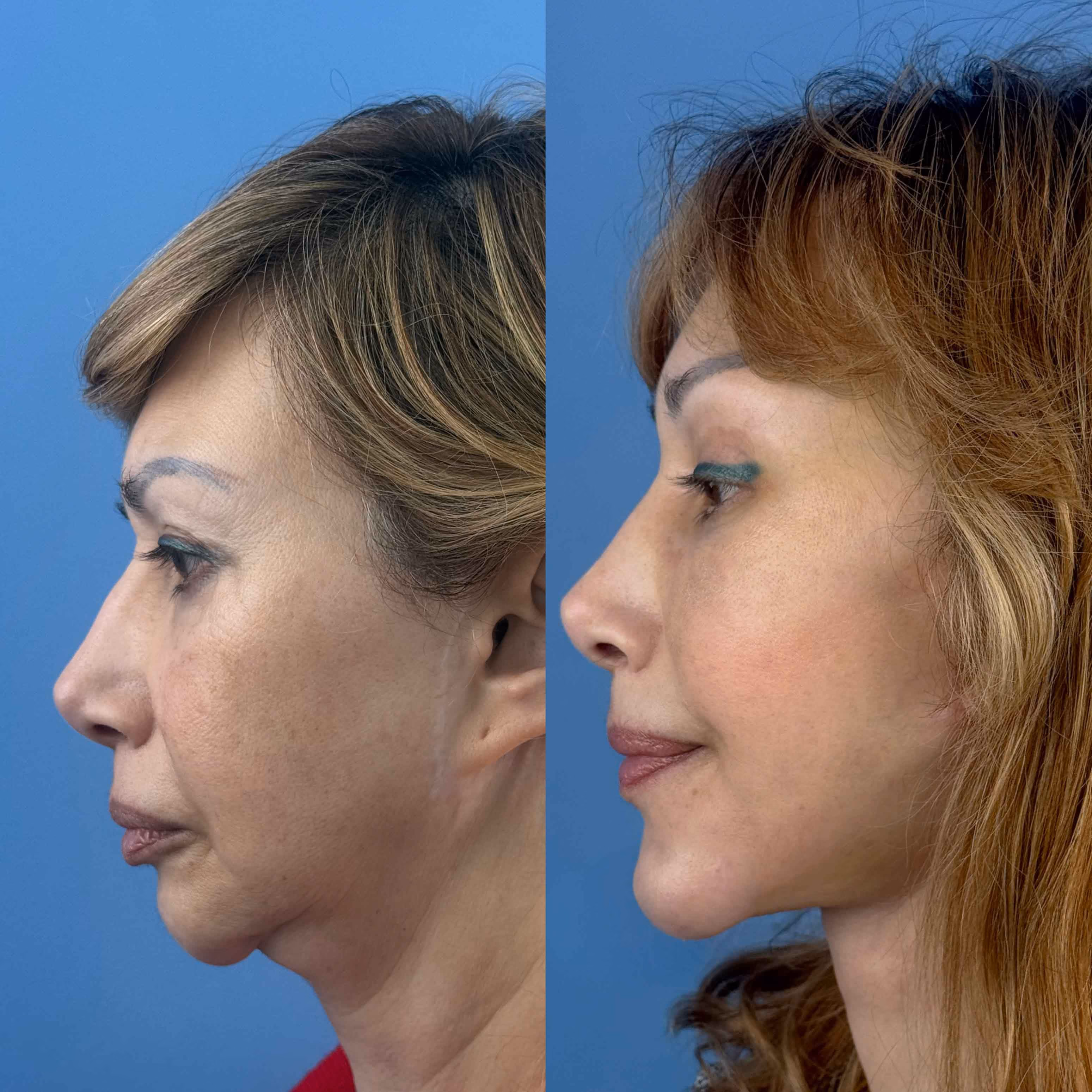 Deep-plane face and neck lift before-and-after, side view