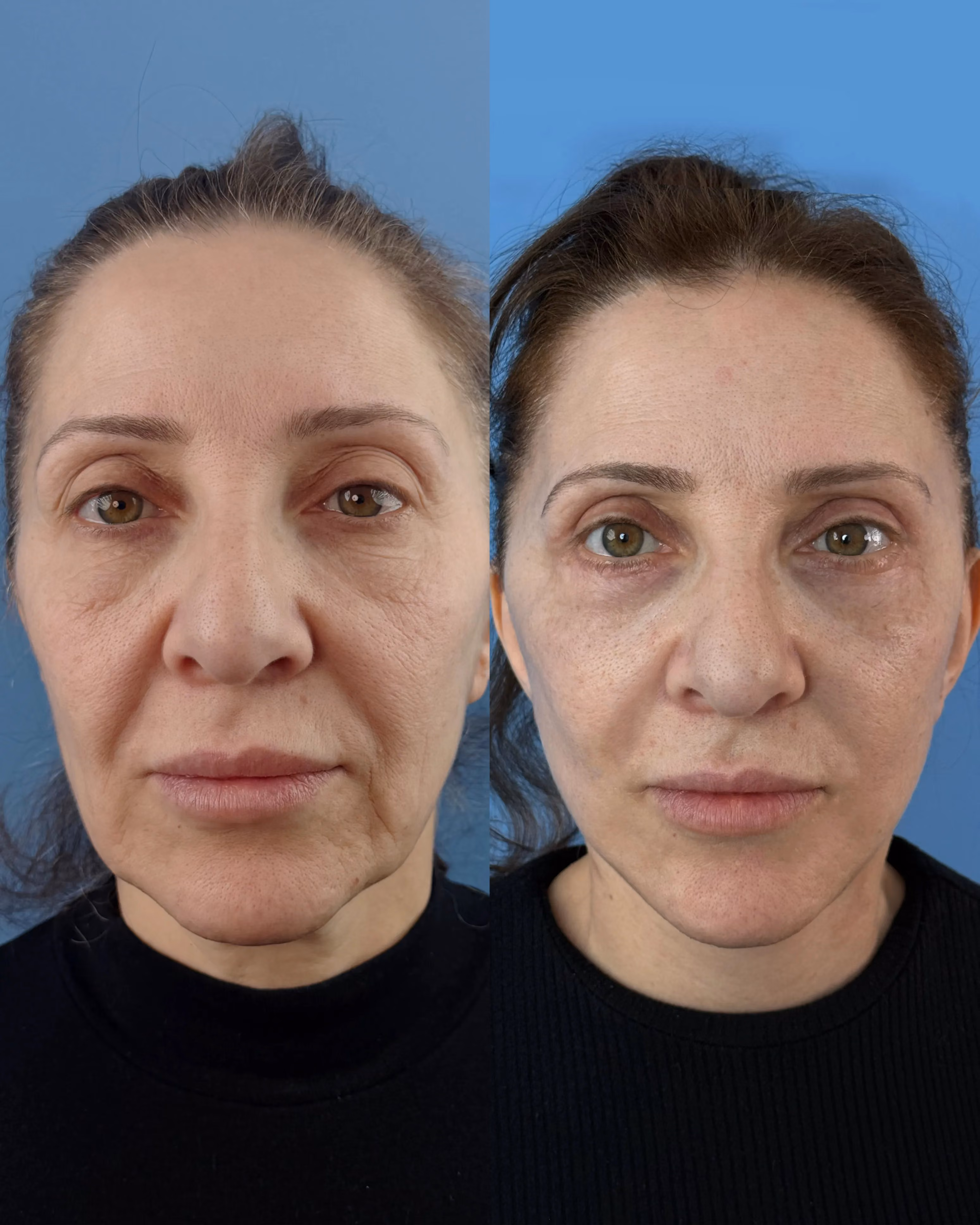Deep-plane face and neck lift postoperative result, three-quarter view