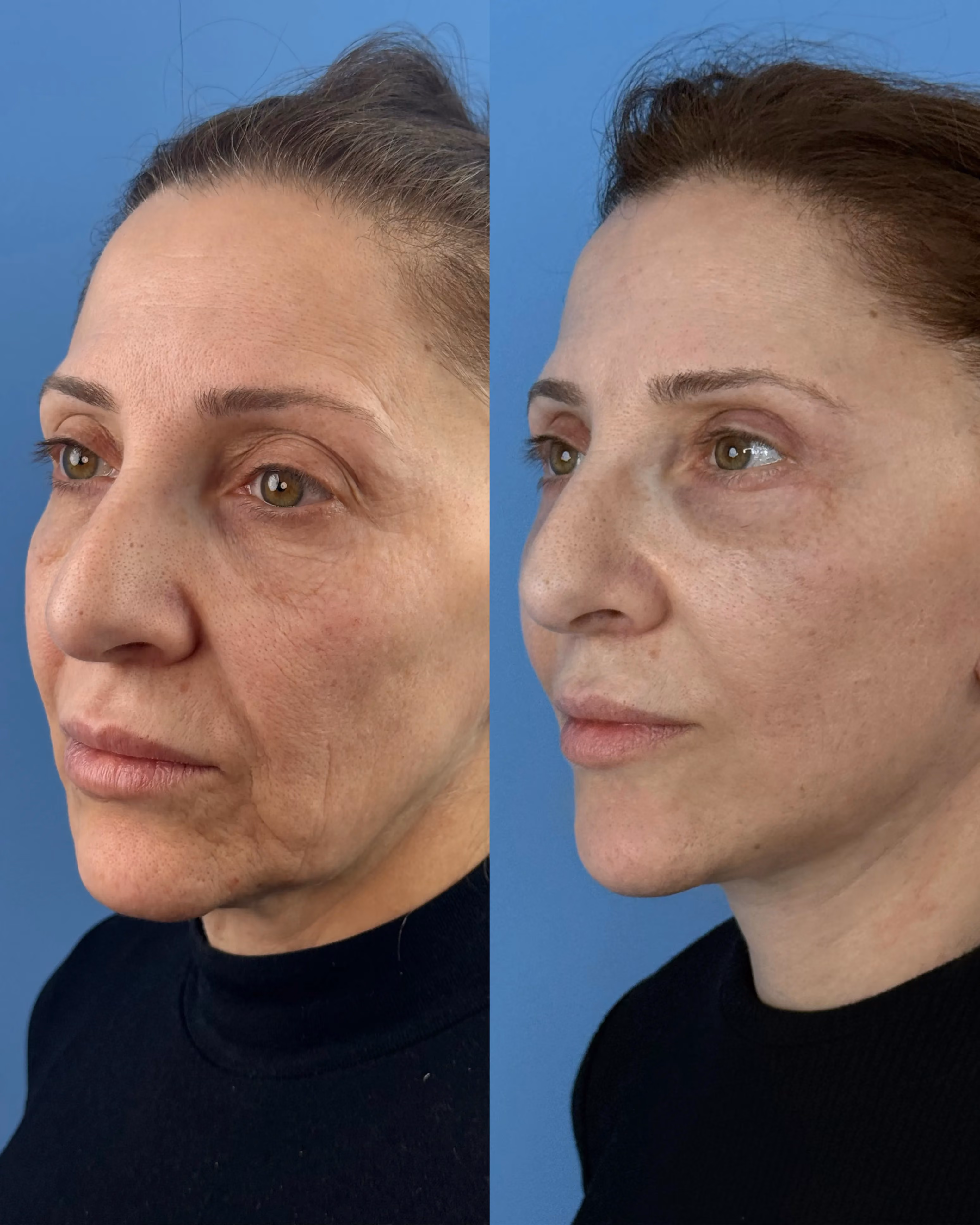 Deep-plane face and neck lift postoperative result, frontal view