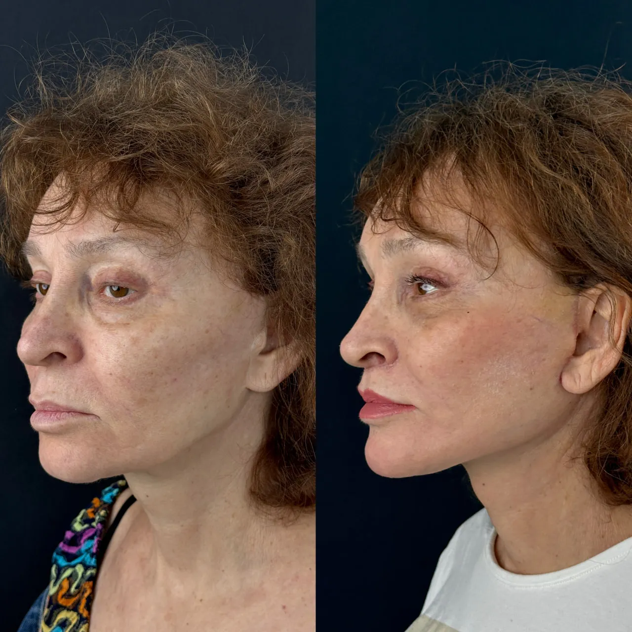 Deep-plane face and neck lift before-and-after, profile view
