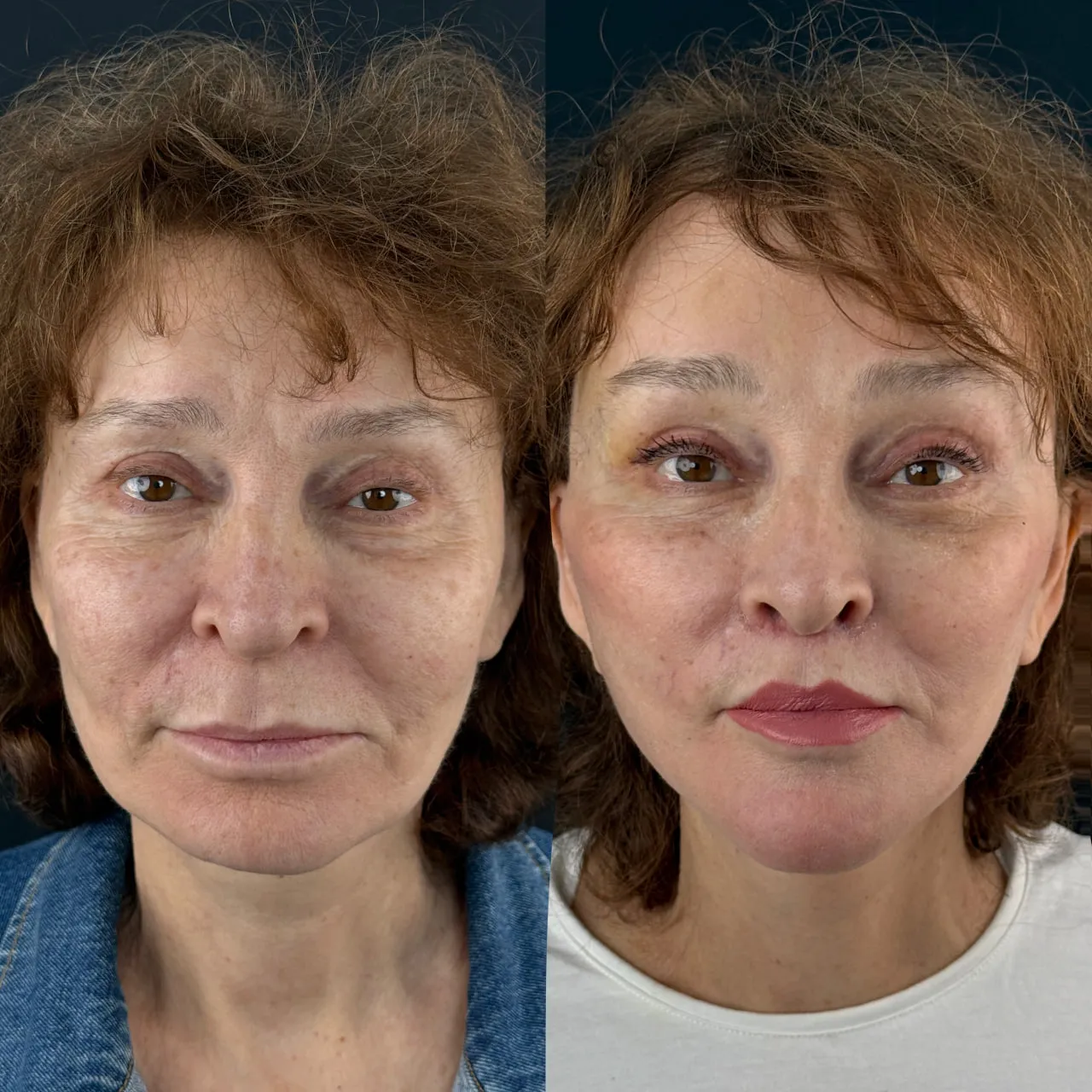 Deep-plane face and neck lift before-and-after, frontal view