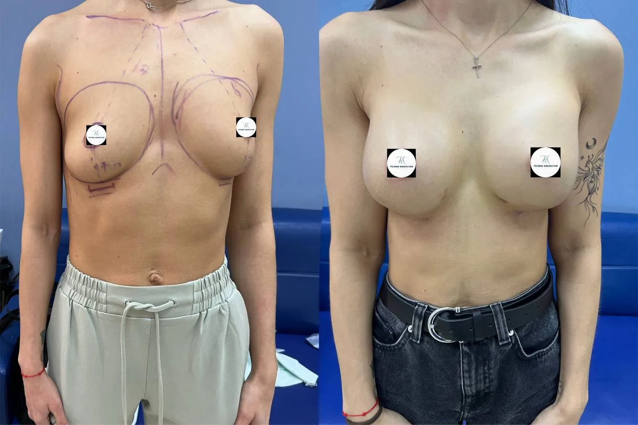 Breast augmentation before-and-after result, case 2, frontal view