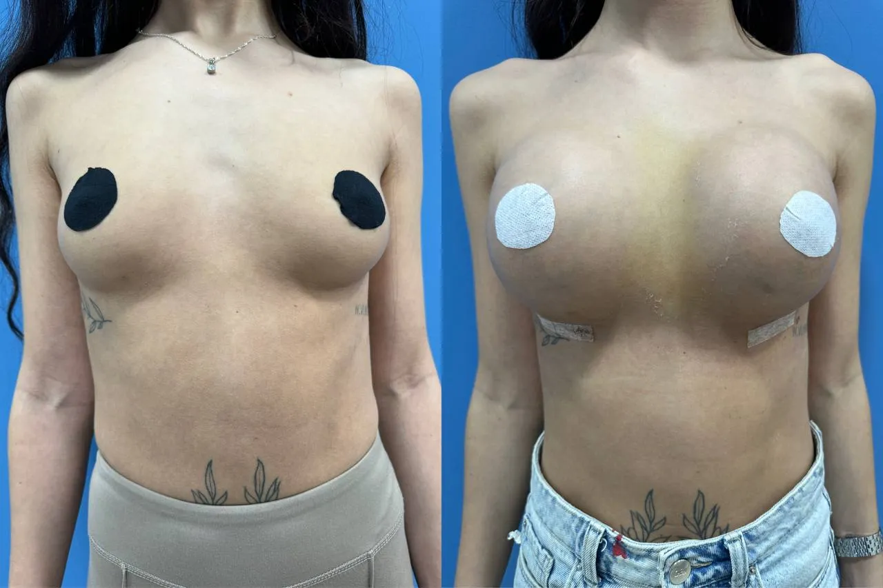 Breast augmentation before-and-after result, case 1, frontal view