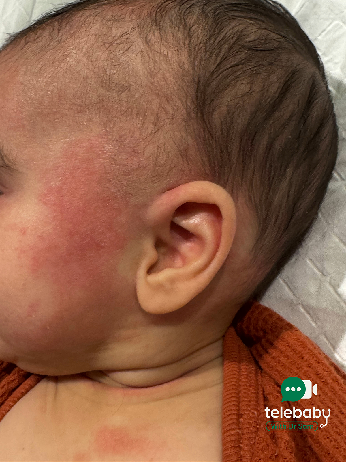 How to Treat Eczema in Babies and Children: A Paediatrician’s Guide