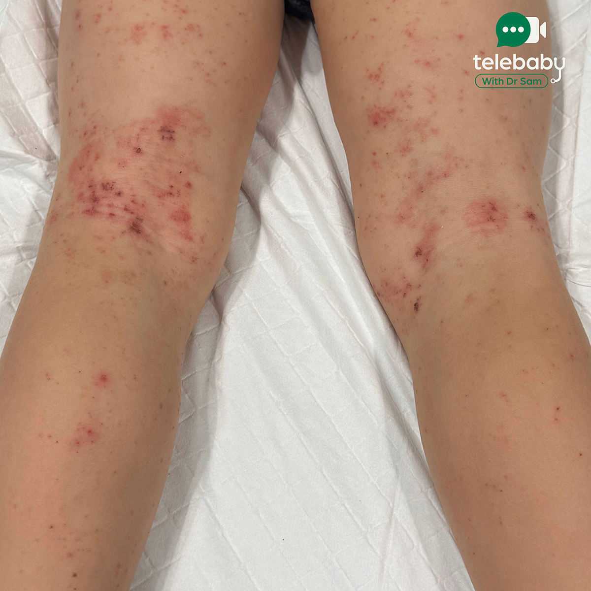 How to Treat Eczema in Babies and Children: A Paediatrician’s Guide