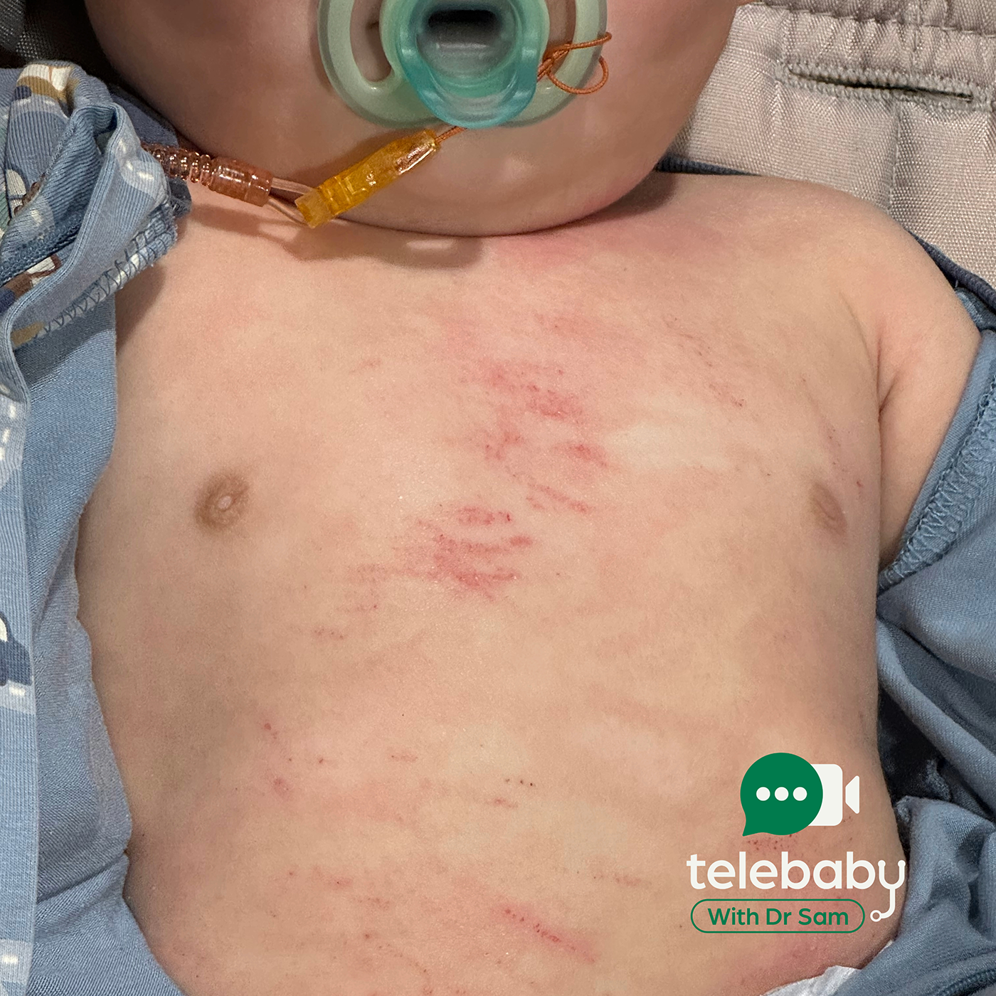 How to Treat Eczema in Babies and Children: A Paediatrician’s Guide