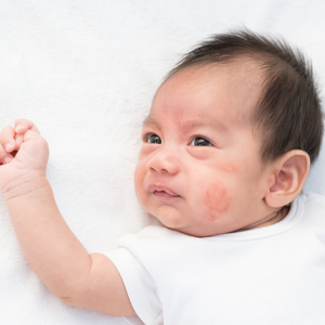 How to Treat Eczema in Babies and Children: A Paediatrician's Guide